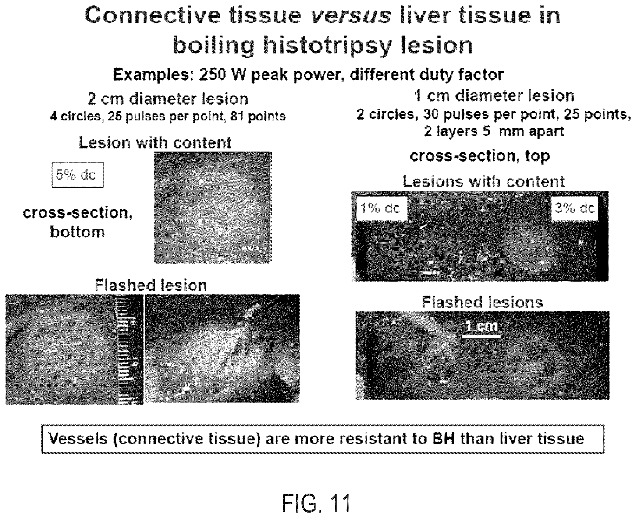 Patent US12157018 Figure 13 – Boiling histotripsy methods and systems for uniform volumetric ablation of an object by high-intensity focused ultrasound waves with shocks