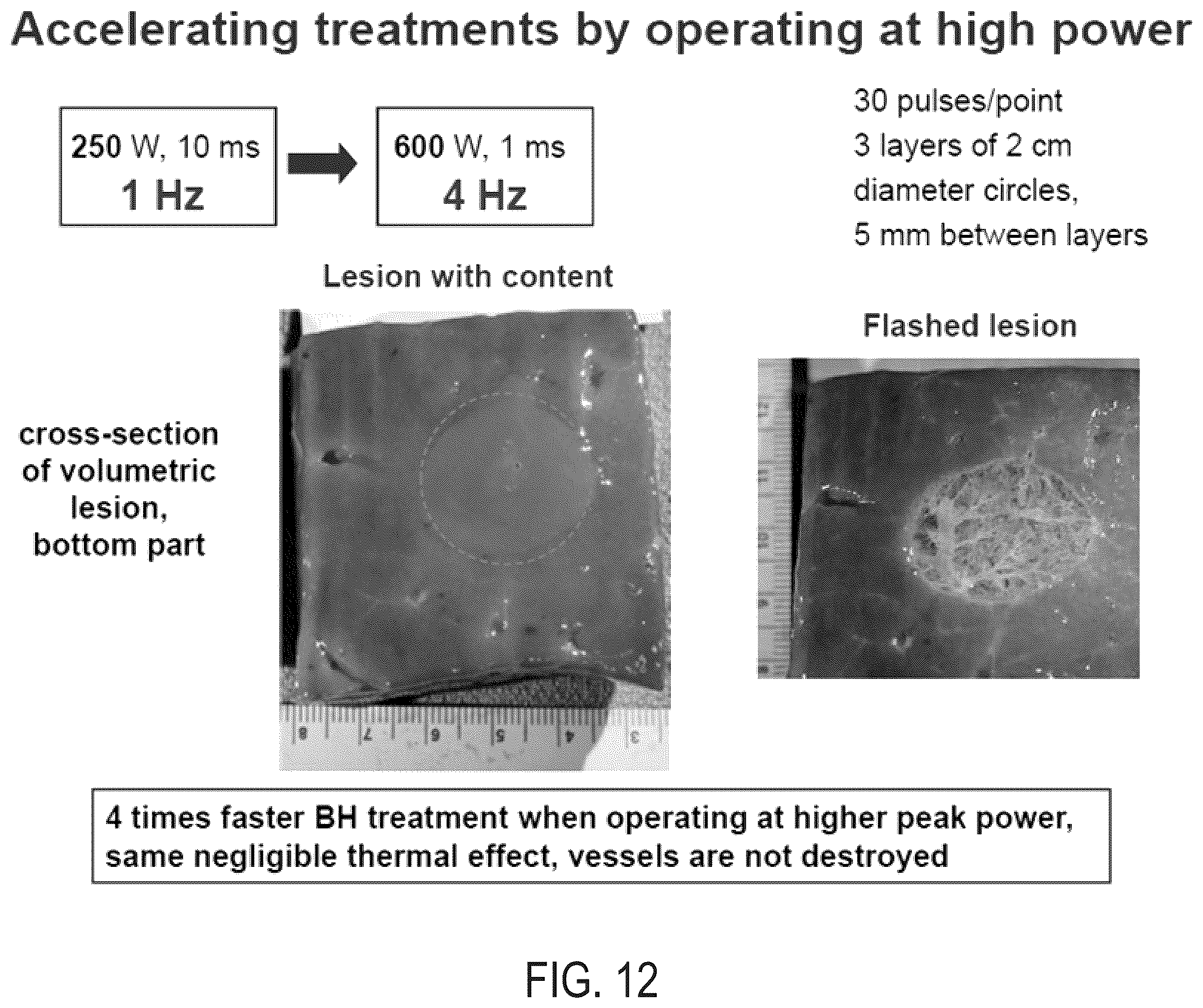 Patent US12157018 Figure 14 – Boiling histotripsy methods and systems for uniform volumetric ablation of an object by high-intensity focused ultrasound waves with shocks