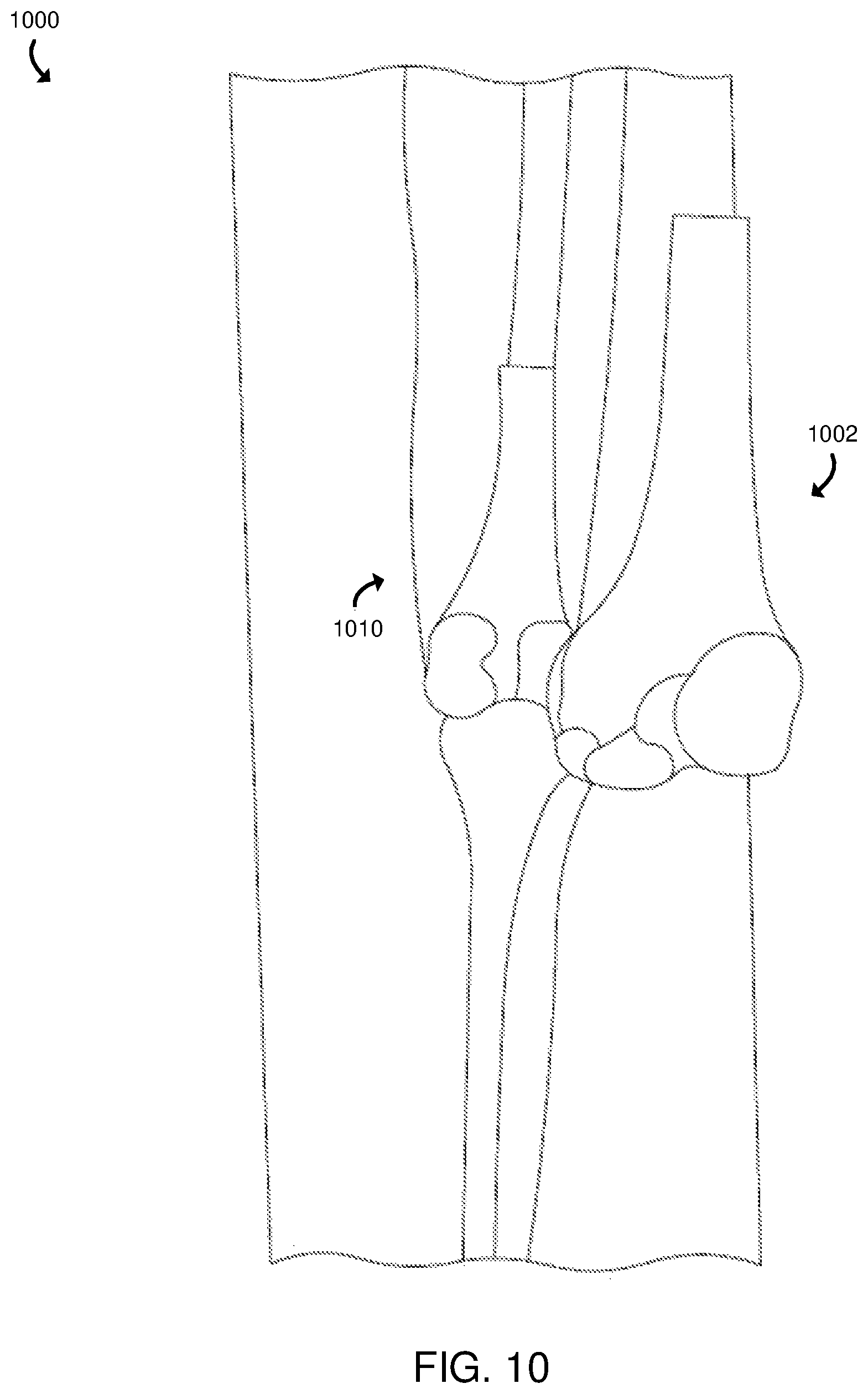 Patent US12165301 Figure 10 – Technologies for determining the accuracy of three-dimensional models for use in an orthopedic surgical procedure