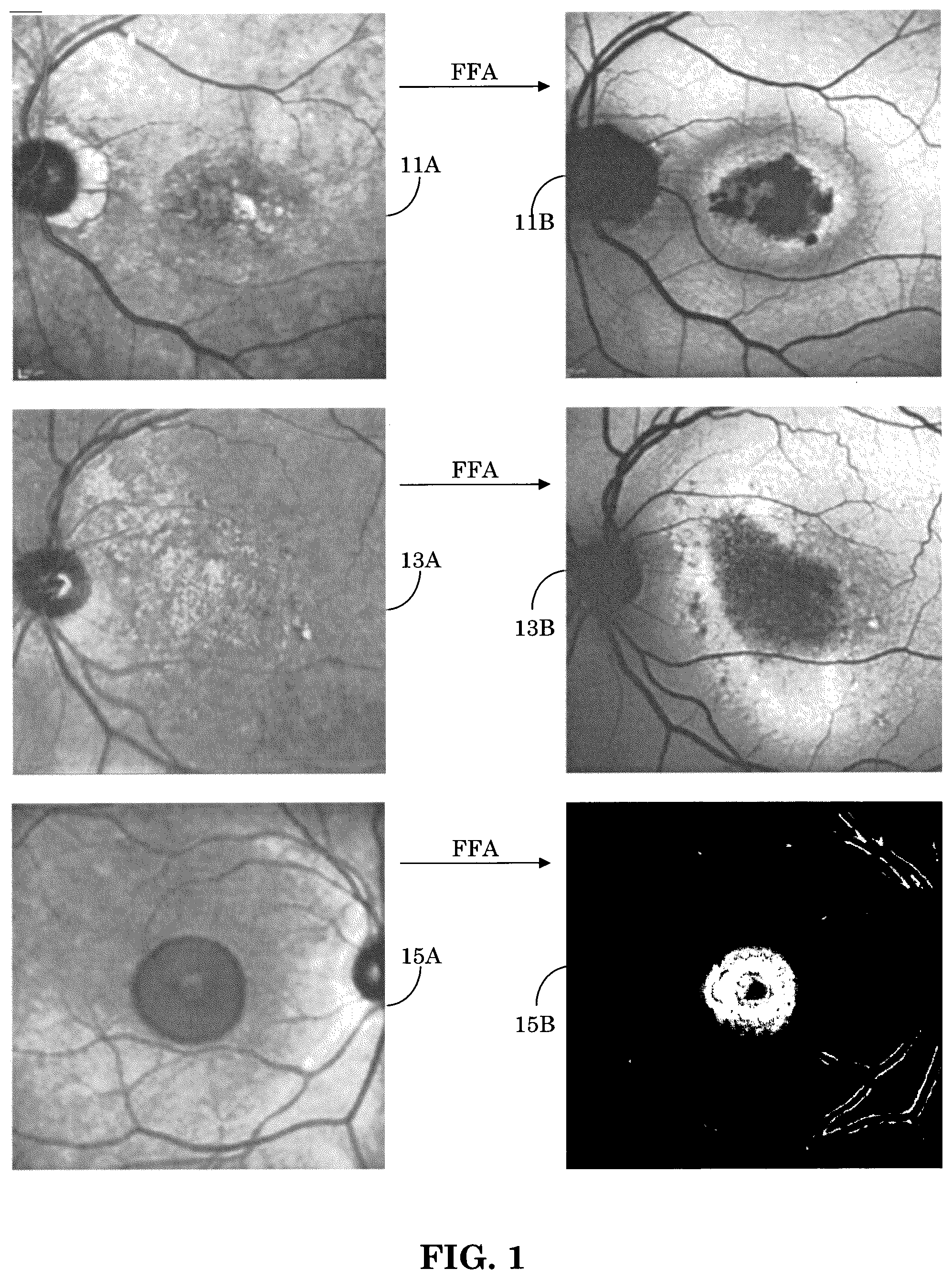 Patent US12165434 Figure 1 – Segmentation and classification of geographic atrophy patterns in patients with age related macular degeneration in widefield autofluorescence images