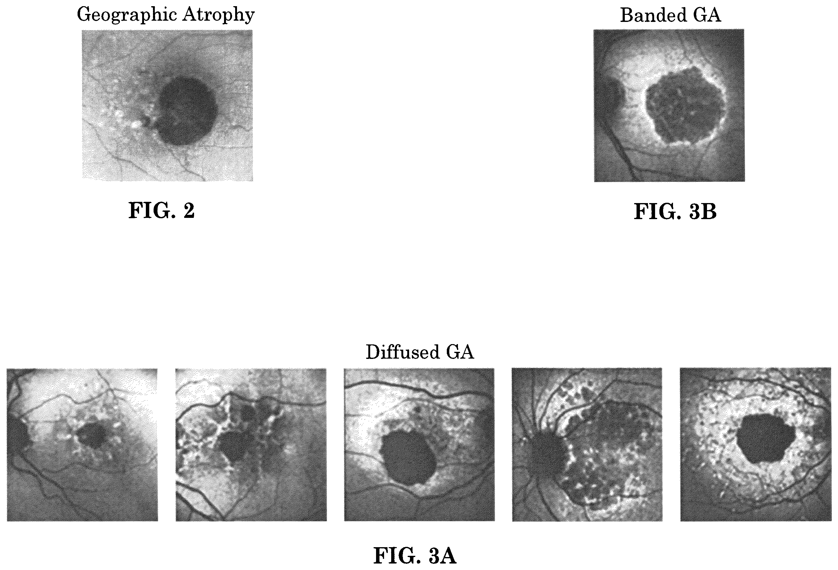 Patent US12165434 Figure 2 – Segmentation and classification of geographic atrophy patterns in patients with age related macular degeneration in widefield autofluorescence images