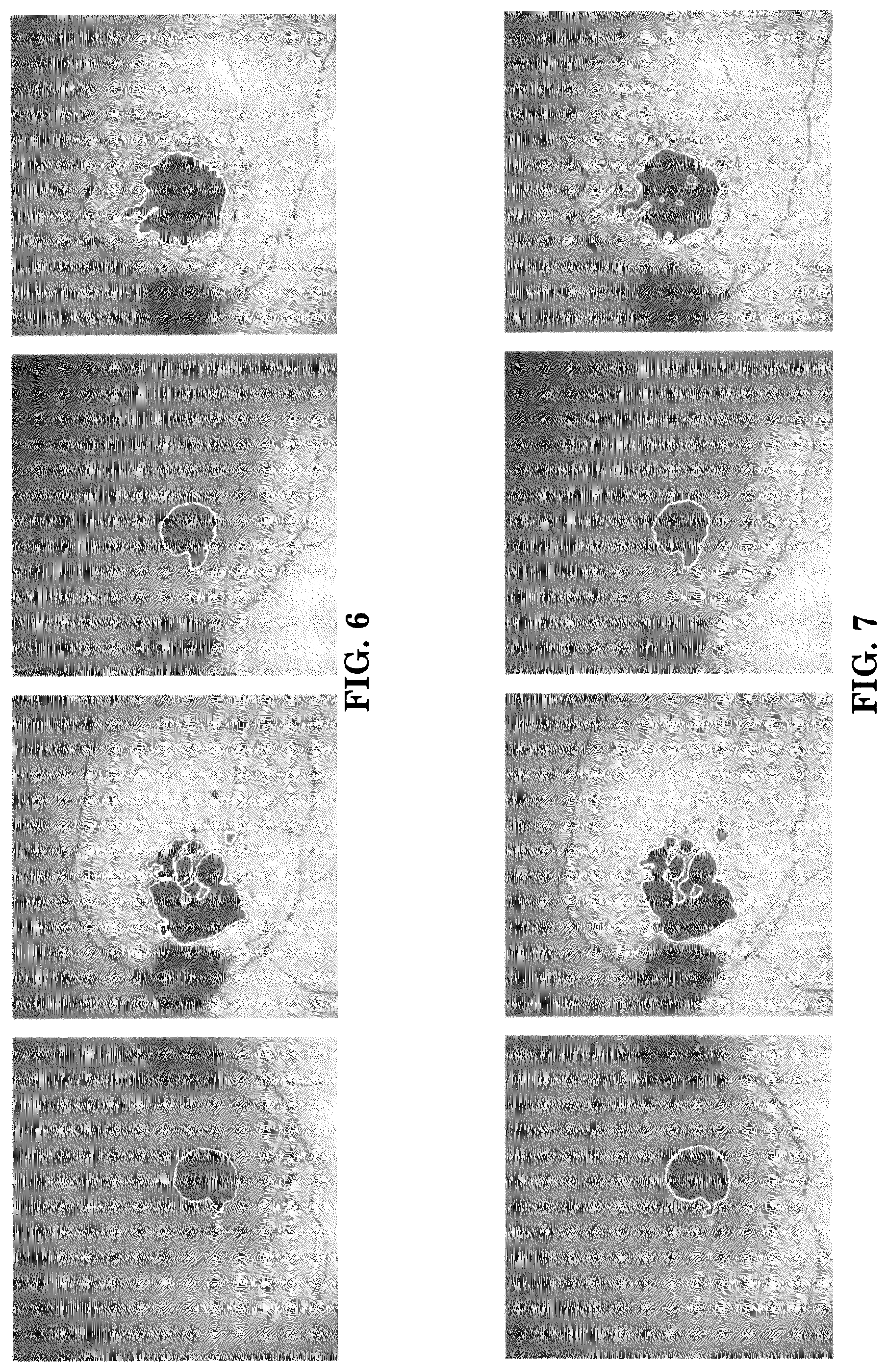 Patent US12165434 Figure 5 – Segmentation and classification of geographic atrophy patterns in patients with age related macular degeneration in widefield autofluorescence images