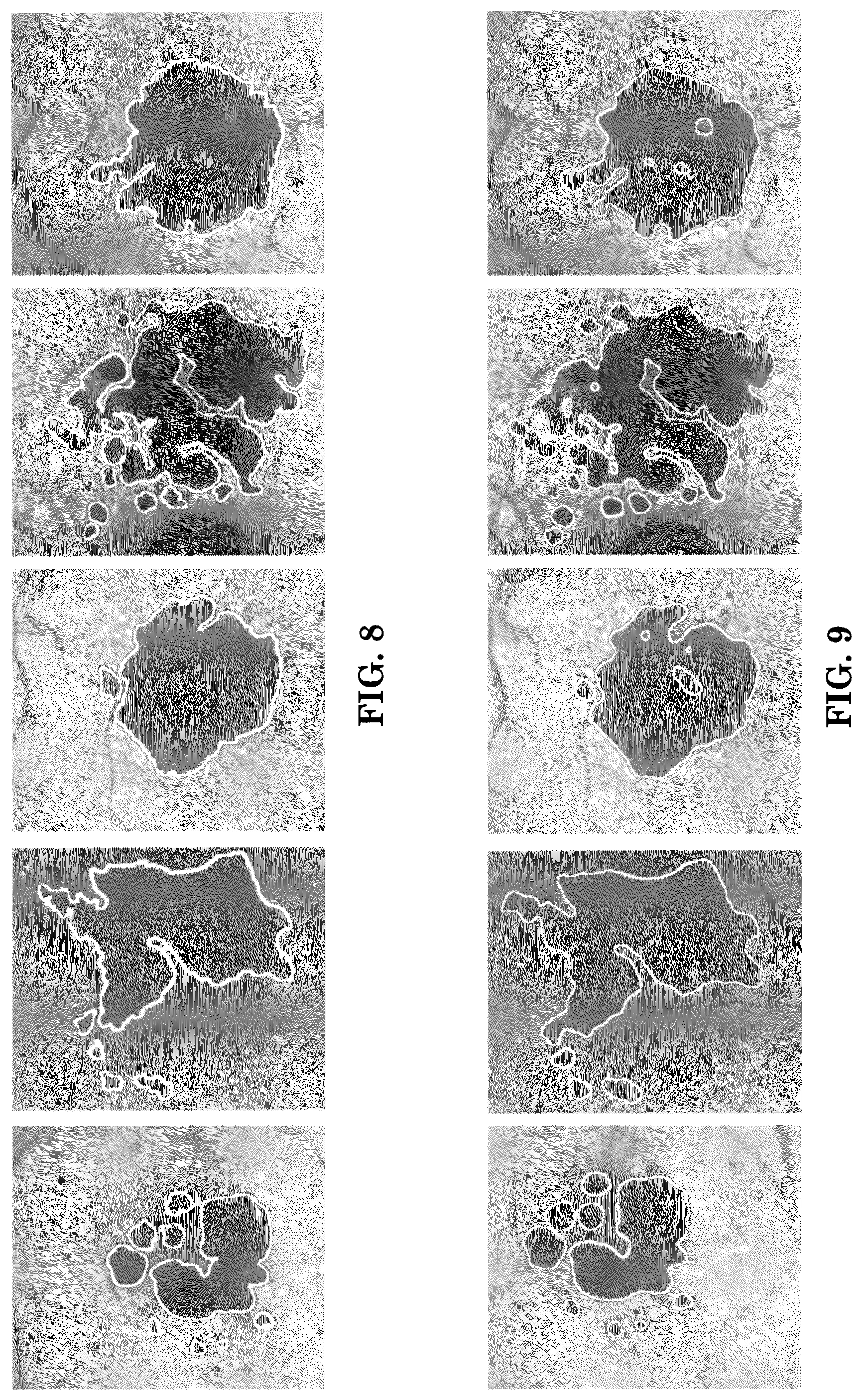 Patent US12165434 Figure 6 – Segmentation and classification of geographic atrophy patterns in patients with age related macular degeneration in widefield autofluorescence images