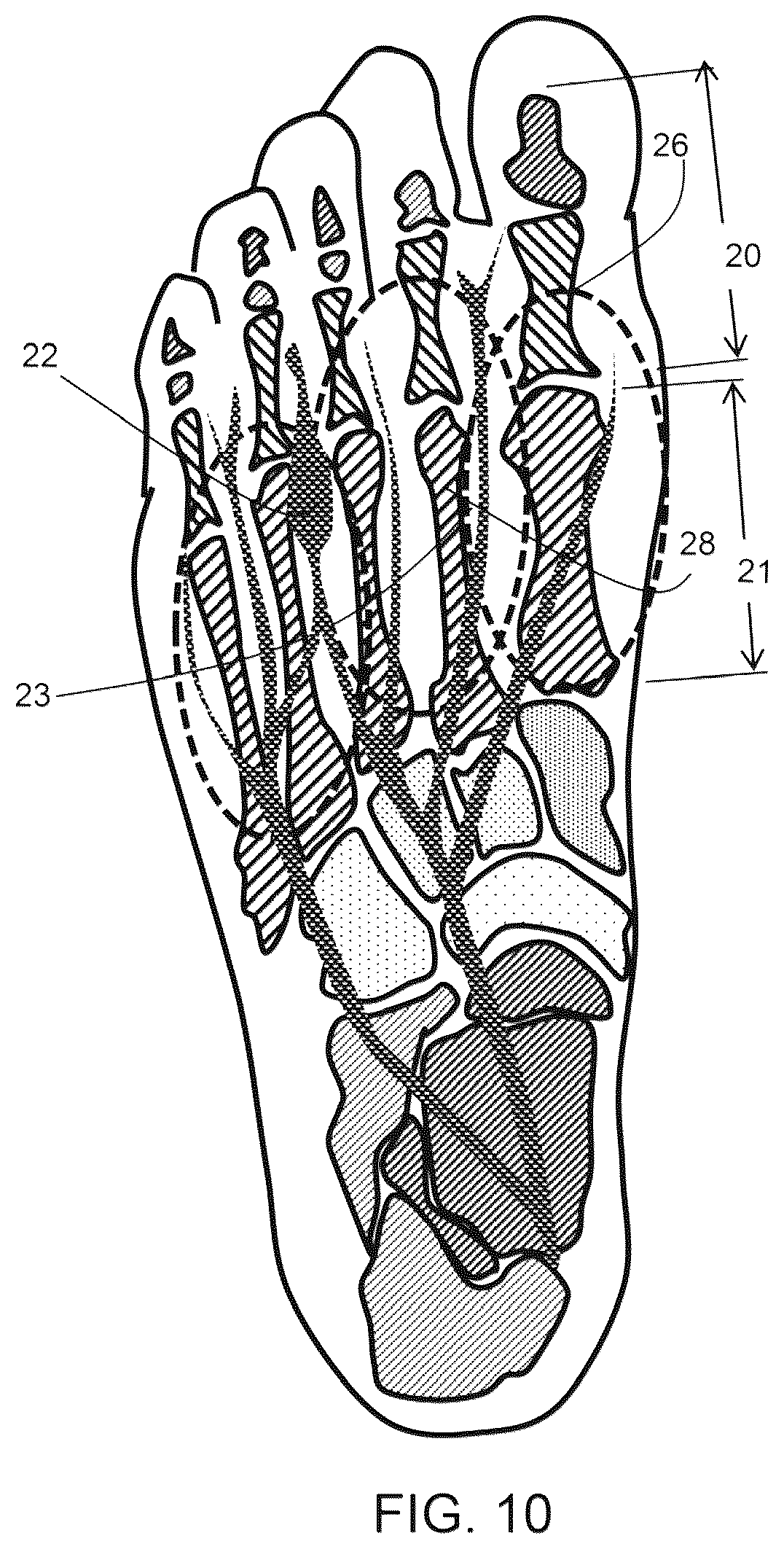Patent US12167775 Figure 7 – Flexible forefoot protection for insoles and shoes