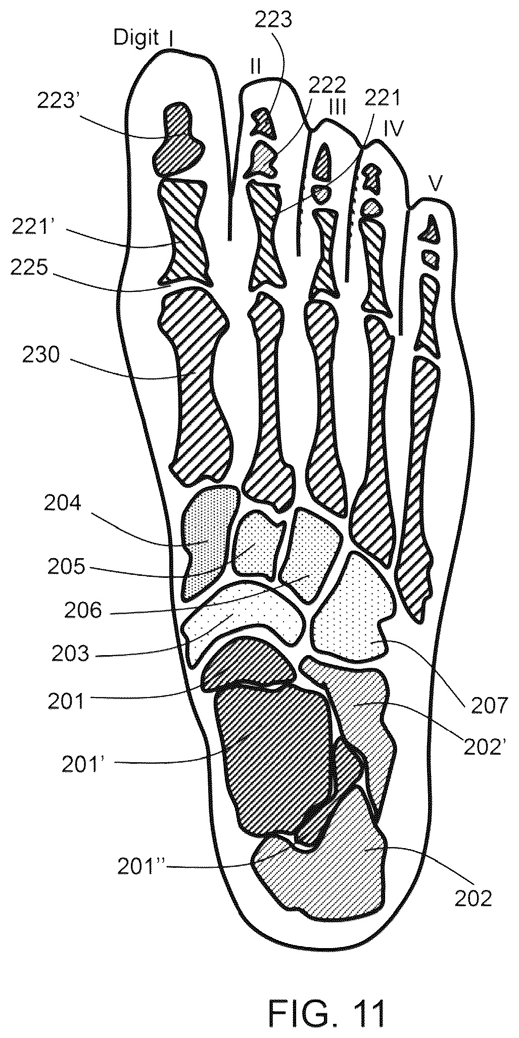 Patent US12167775 Figure 8 – Flexible forefoot protection for insoles and shoes