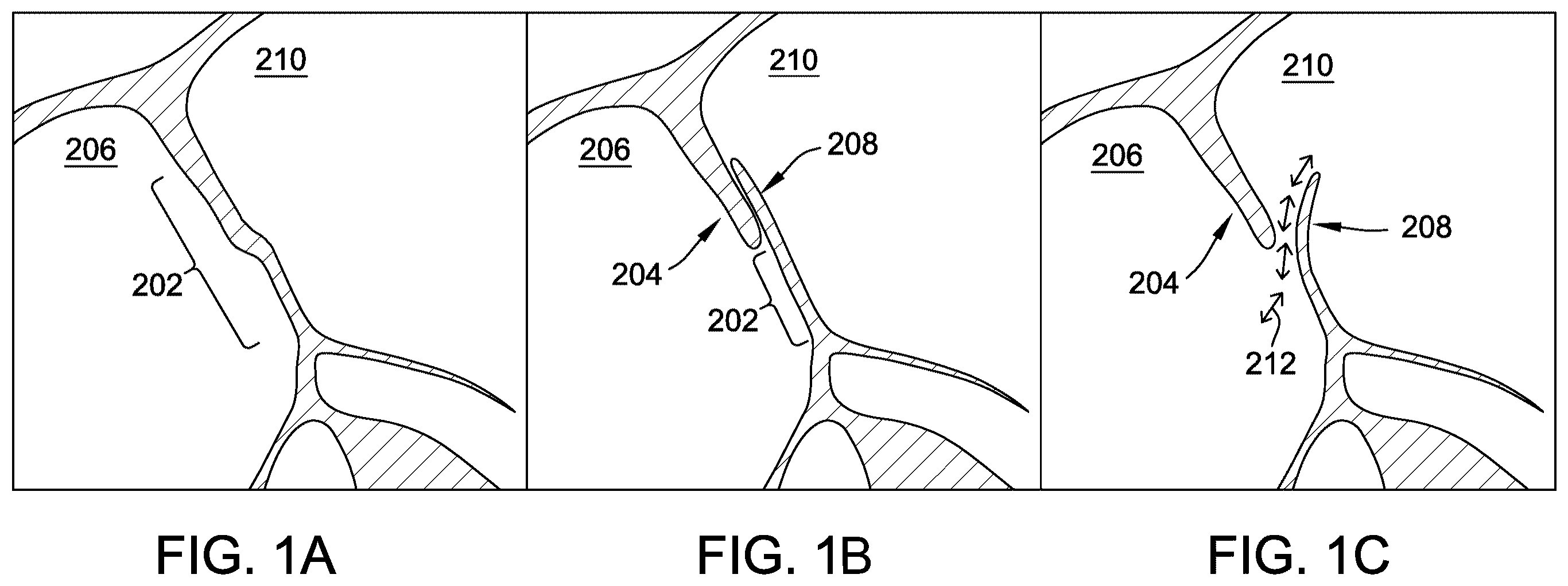 Patent US12167843 Figure 1 – Patent foramen ovale (PFO) tunnel filler