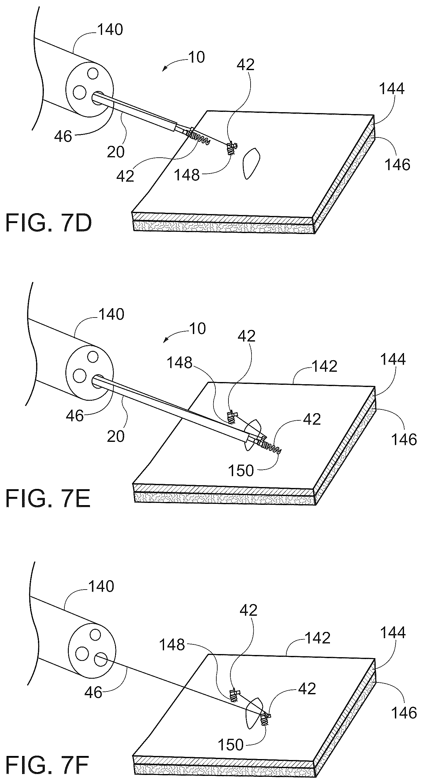 Patent US12167844 Figure 7 – Endoscopic tissue approximation system and methods