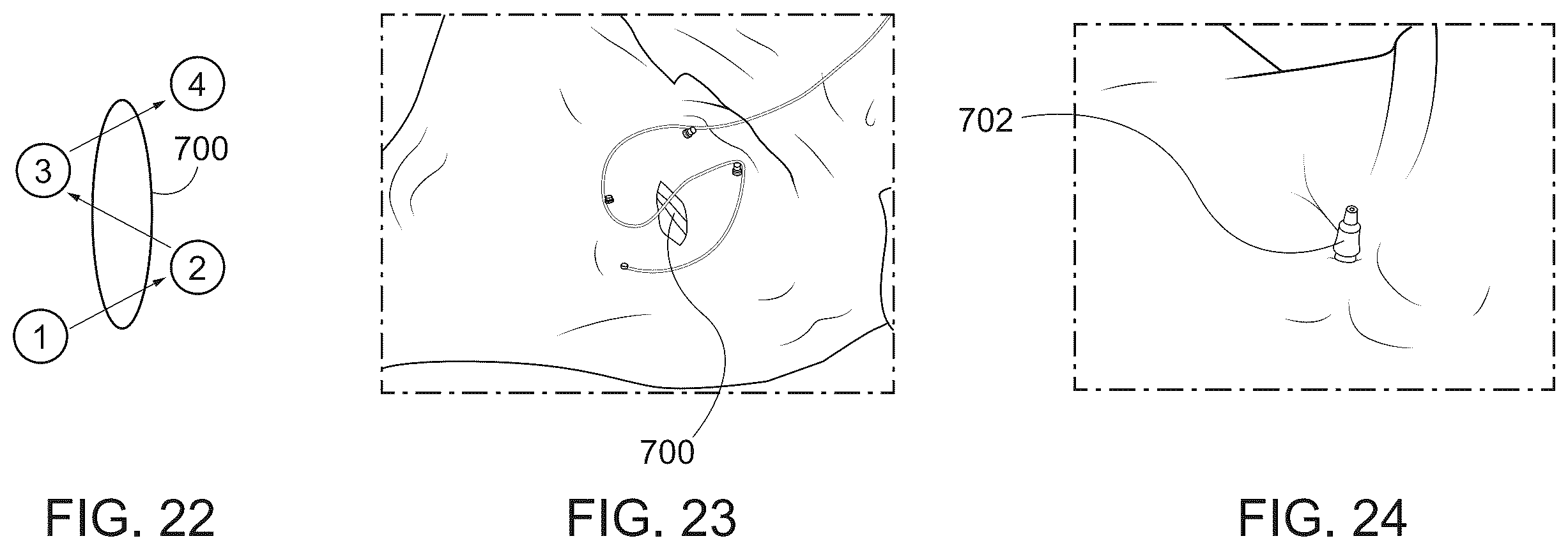 Patent US12167844 Figure 14 – Endoscopic tissue approximation system and methods
