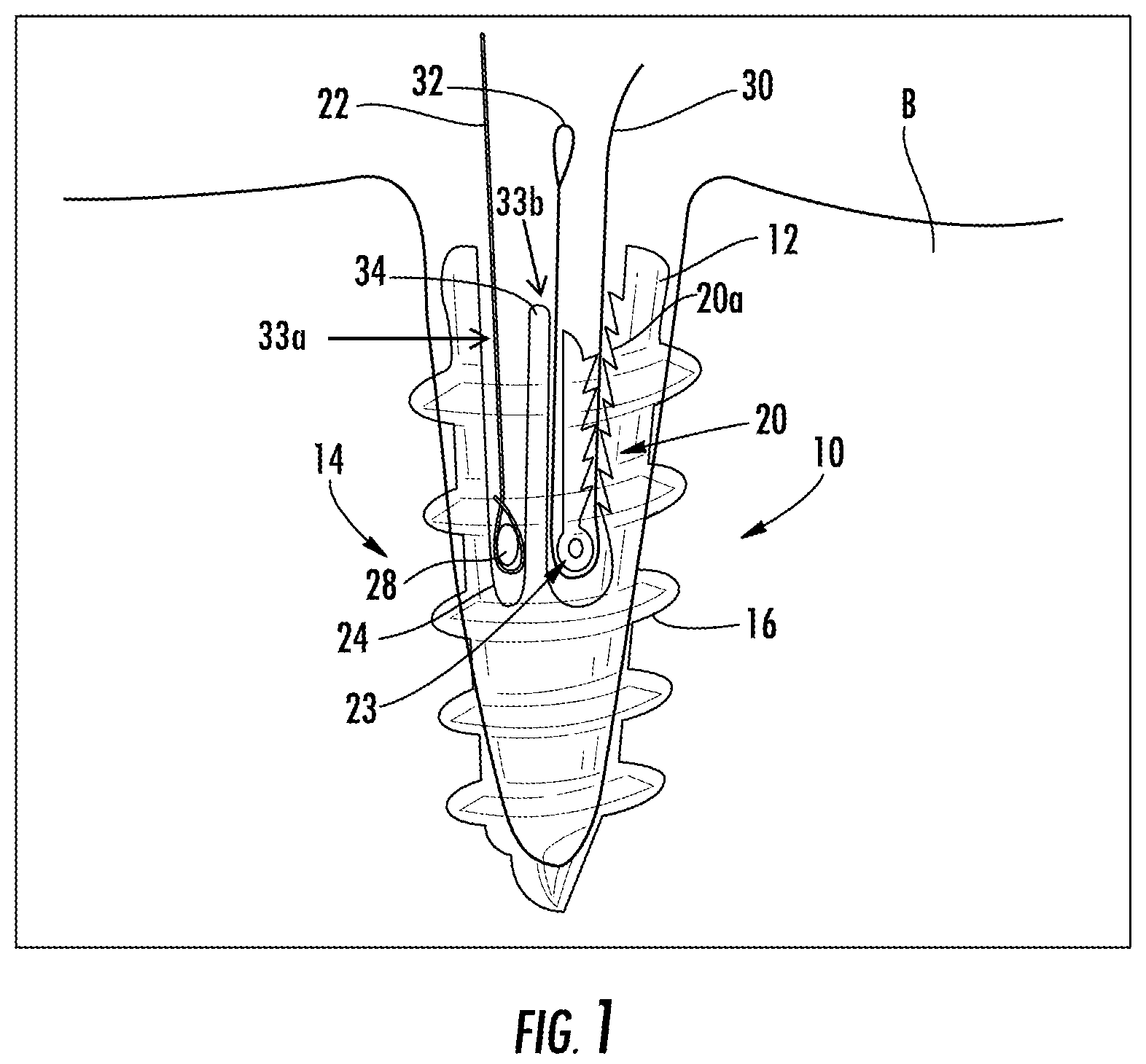 Patent US12167845 — Knotless suture anchor with internal suture locking mechanism — Figure 1