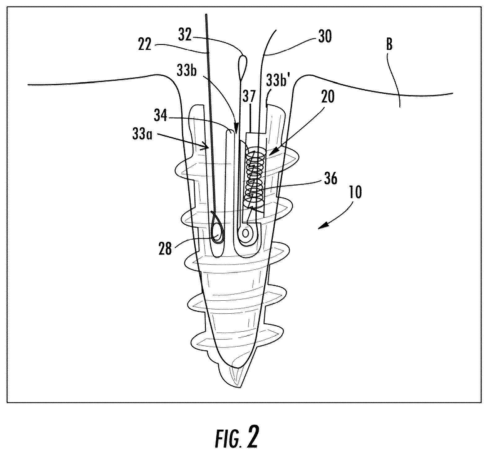 Patent US12167845 Figure 2 – Knotless suture anchor with internal suture locking mechanism