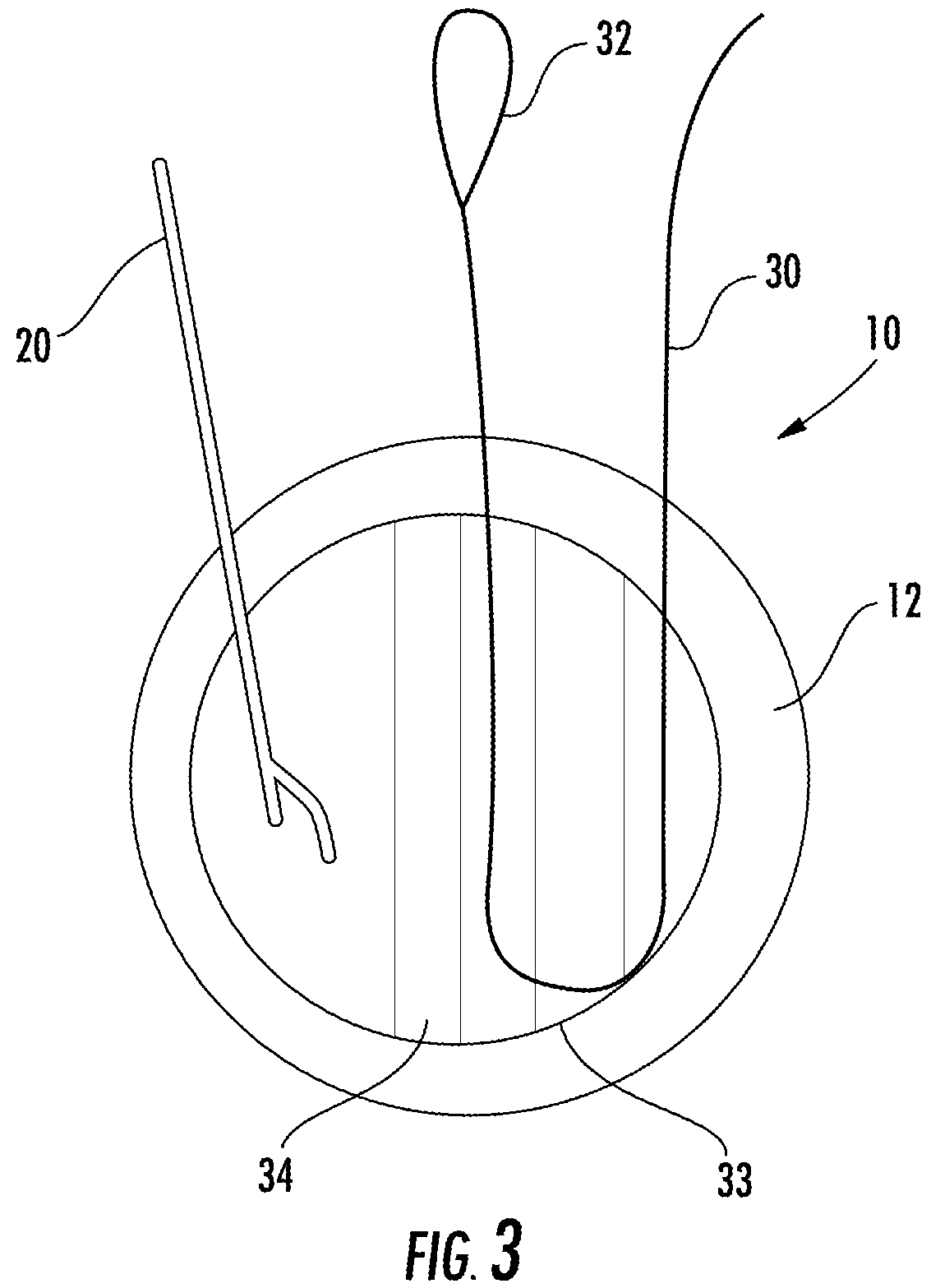 Patent US12167845 Figure 3 – Knotless suture anchor with internal suture locking mechanism