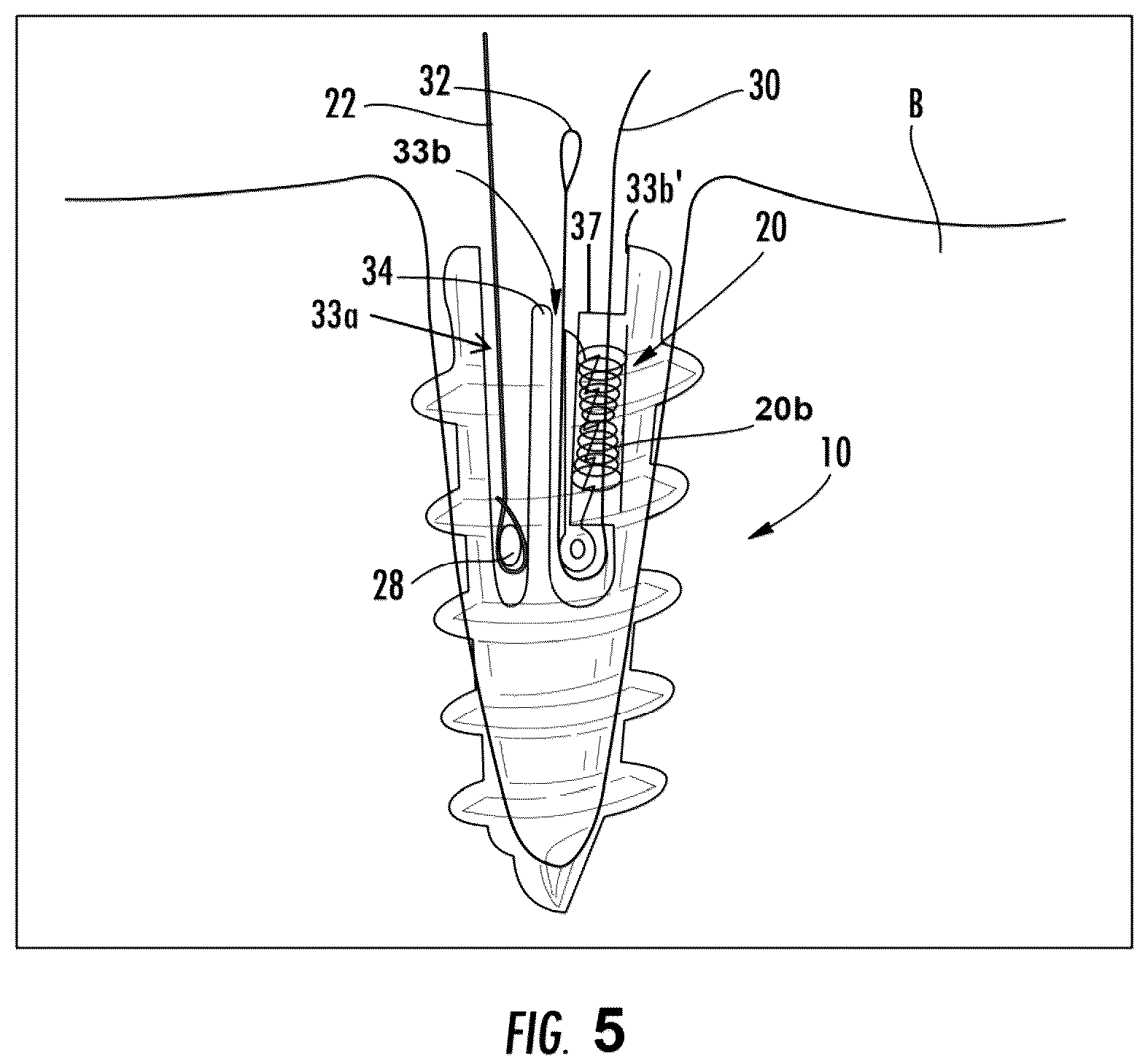 Patent US12167845 Figure 5 – Knotless suture anchor with internal suture locking mechanism