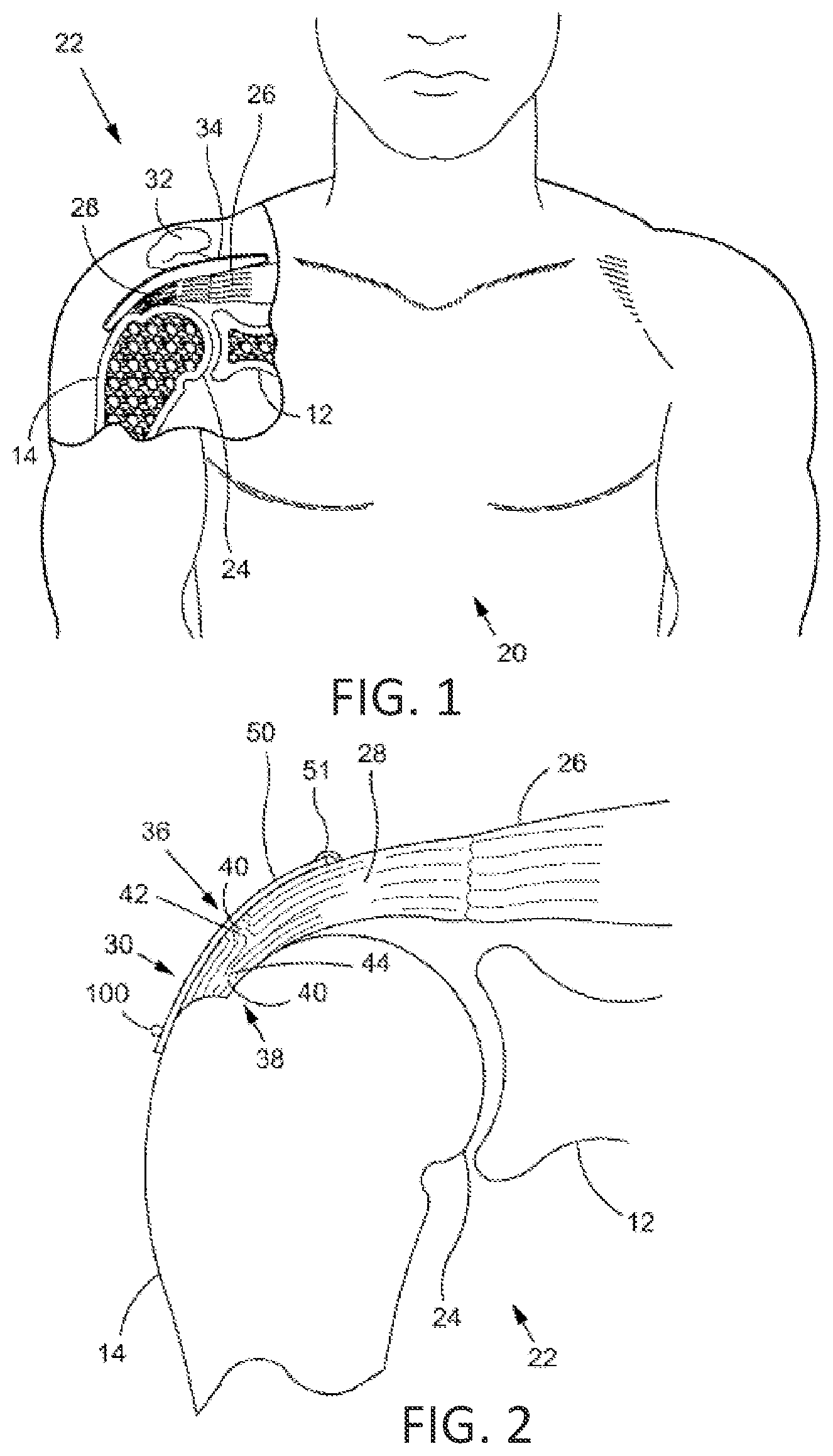 Patent US12167848 Figure 1 – Bone anchor delivery system