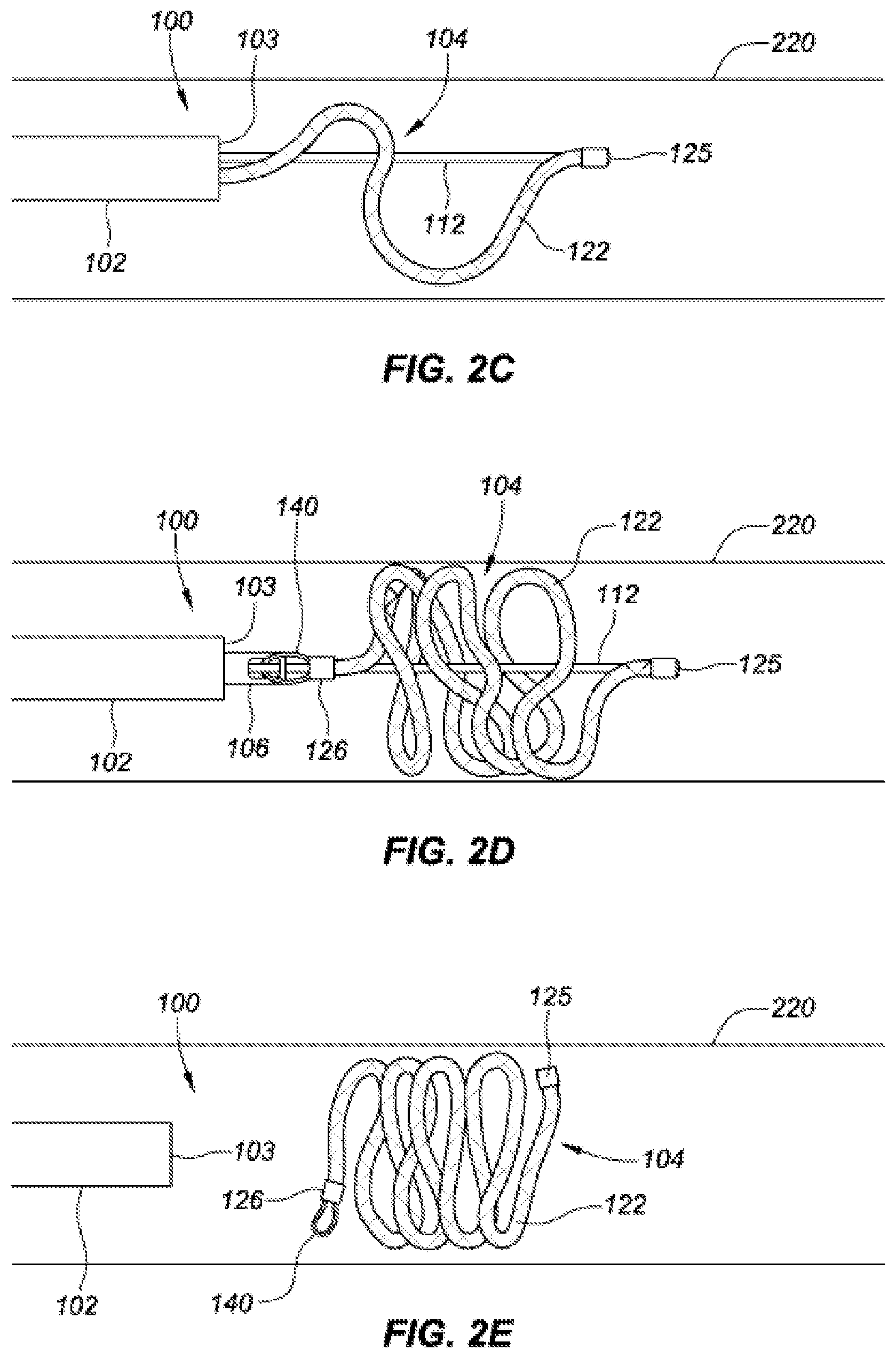 Patent US12167854 Figure 5 – Occlusive implants with fiber-based release structures