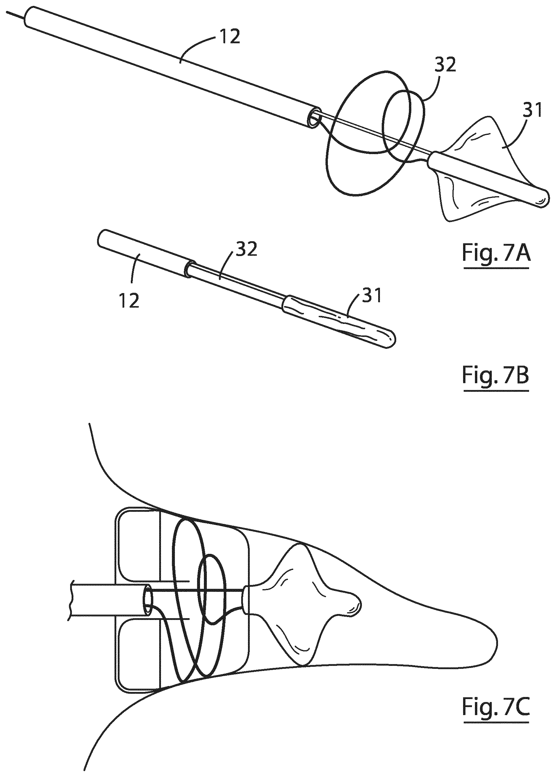 Patent US12167855 Figure 9 – Device for implantation in a left atrial appendage of the heart