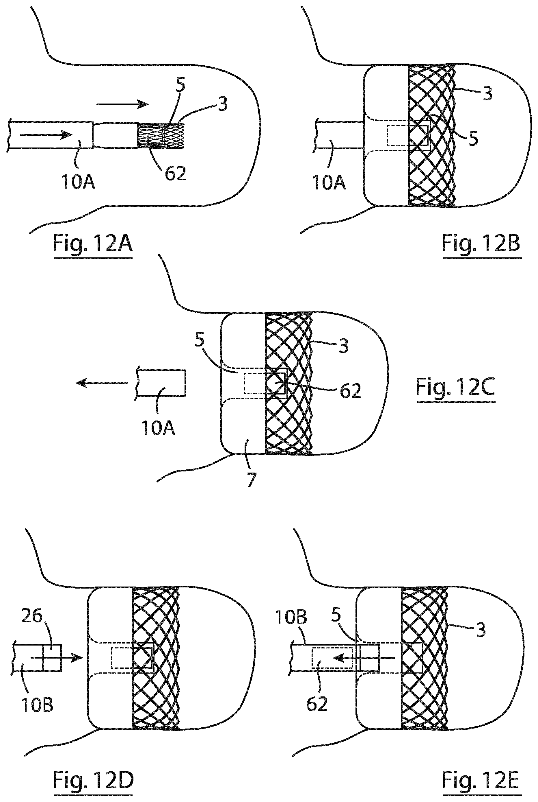 Patent US12167855 Figure 12 – Device for implantation in a left atrial appendage of the heart