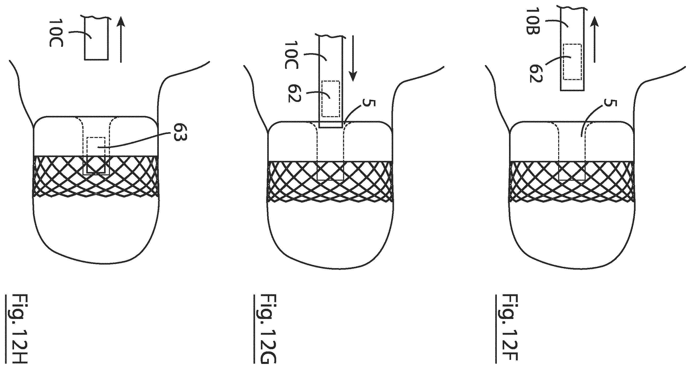 Patent US12167855 Figure 13 – Device for implantation in a left atrial appendage of the heart