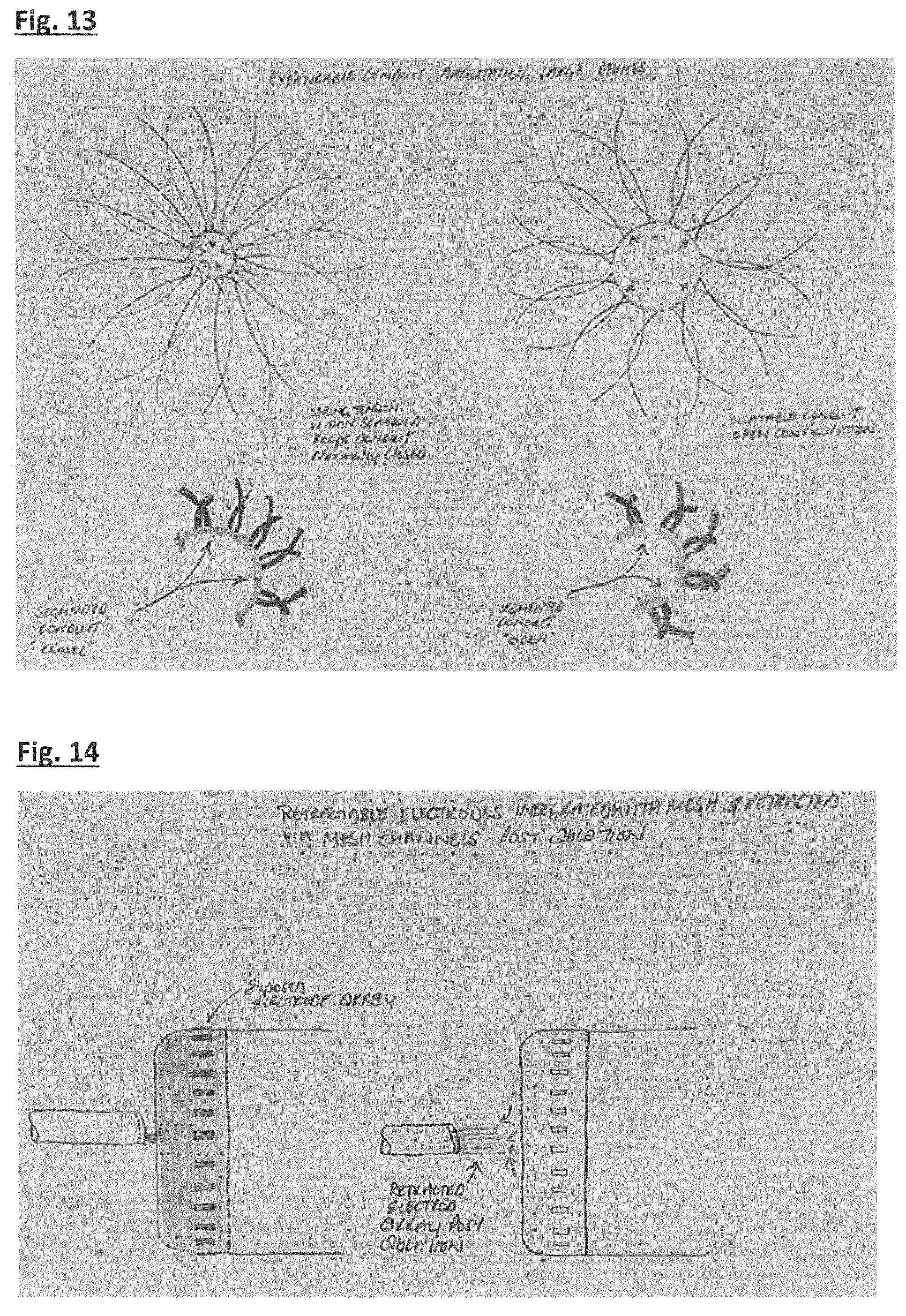 Patent US12167855 Figure 14 – Device for implantation in a left atrial appendage of the heart