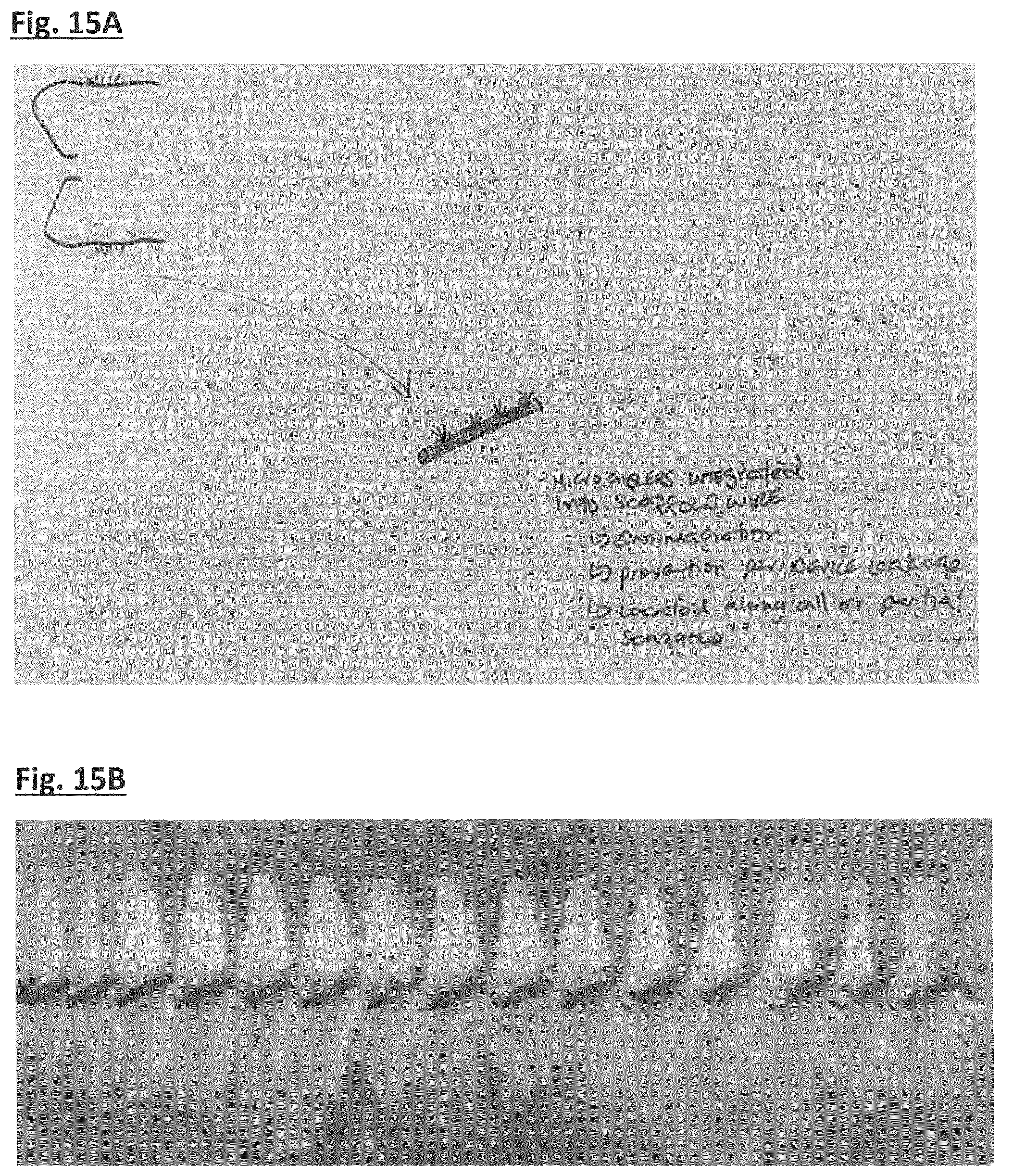Patent US12167855 Figure 15 – Device for implantation in a left atrial appendage of the heart