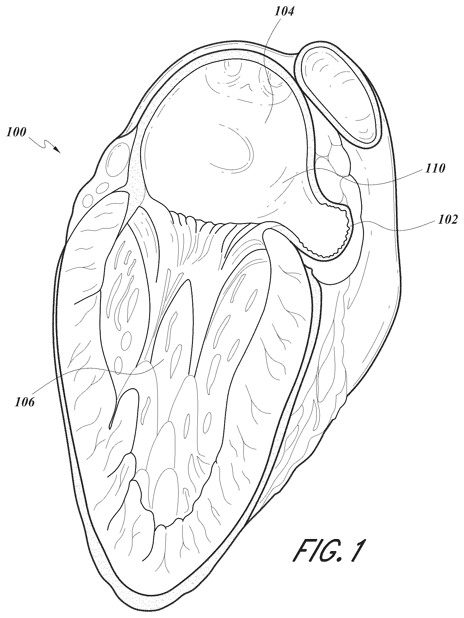 Patent US12167856 Figure 1 – Devices and methods for excluding the left atrial appendage