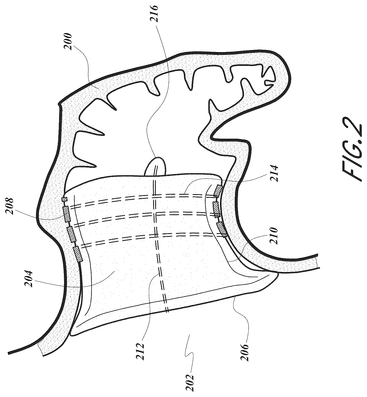 Patent US12167856 Figure 2 – Devices and methods for excluding the left atrial appendage
