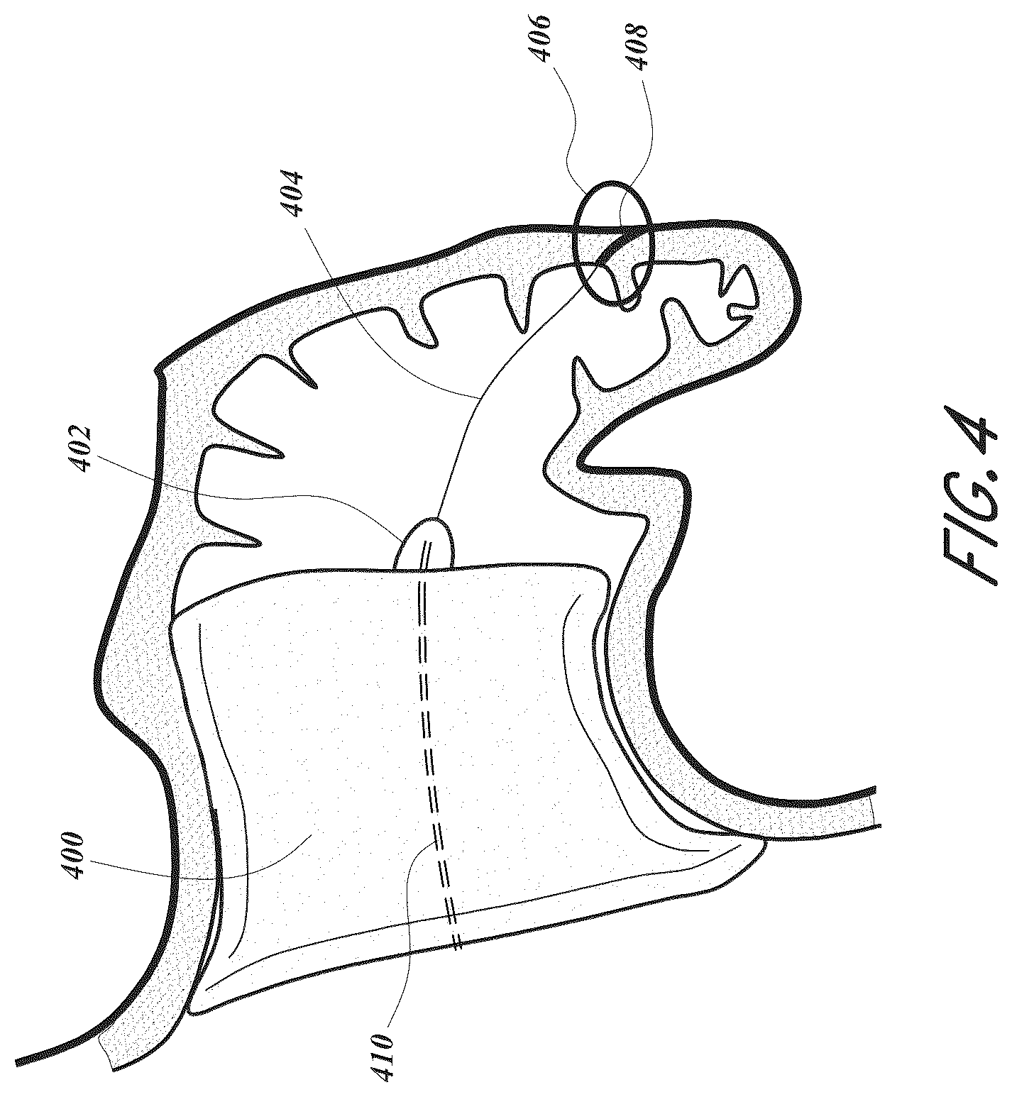 Patent US12167856 Figure 4 – Devices and methods for excluding the left atrial appendage