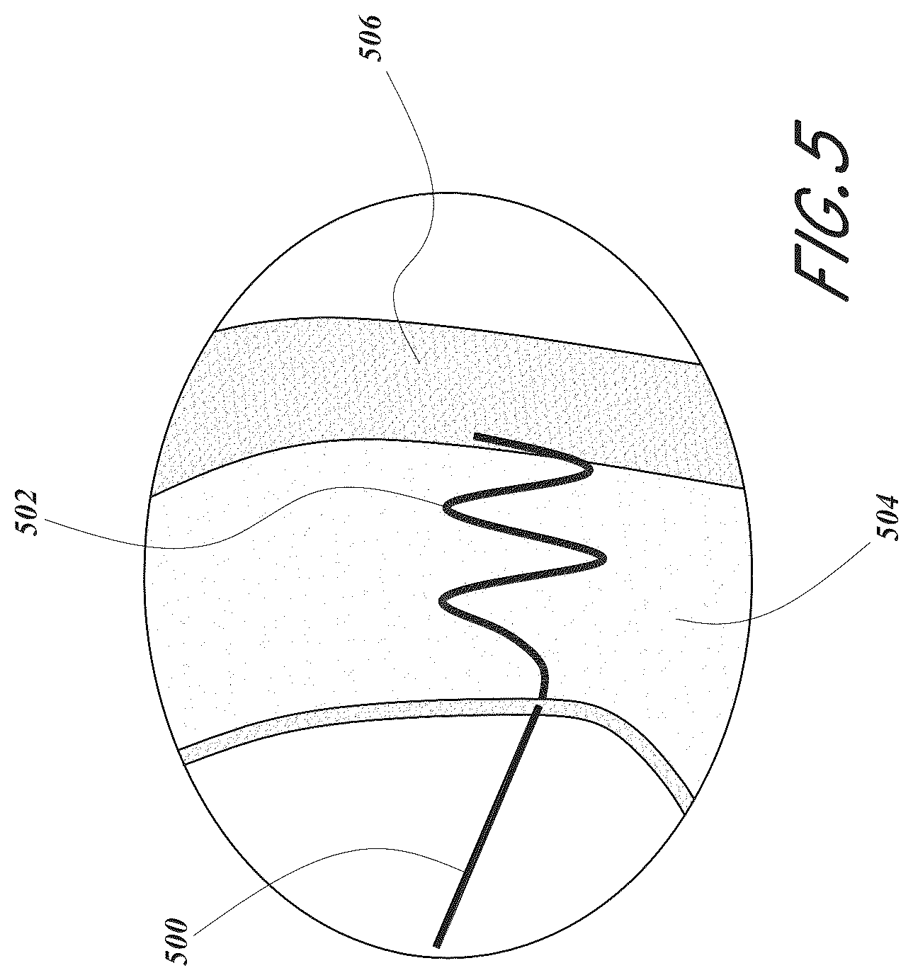 Patent US12167856 Figure 5 – Devices and methods for excluding the left atrial appendage
