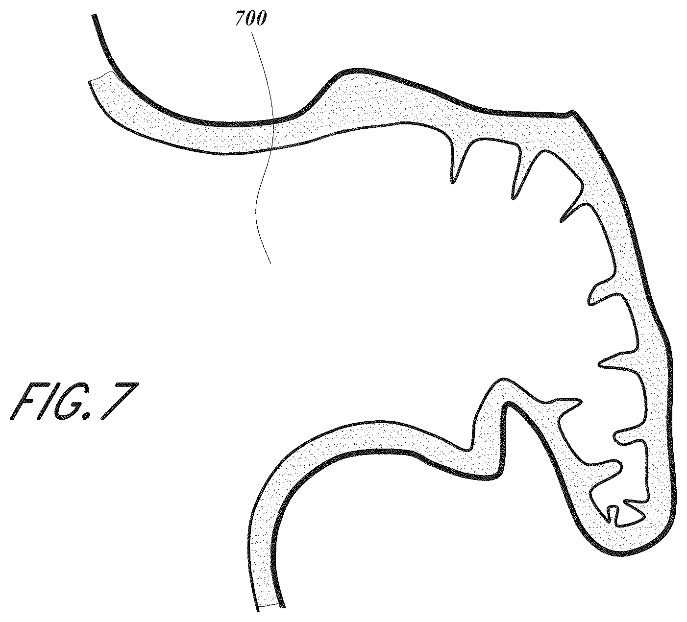 Patent US12167856 Figure 7 – Devices and methods for excluding the left atrial appendage