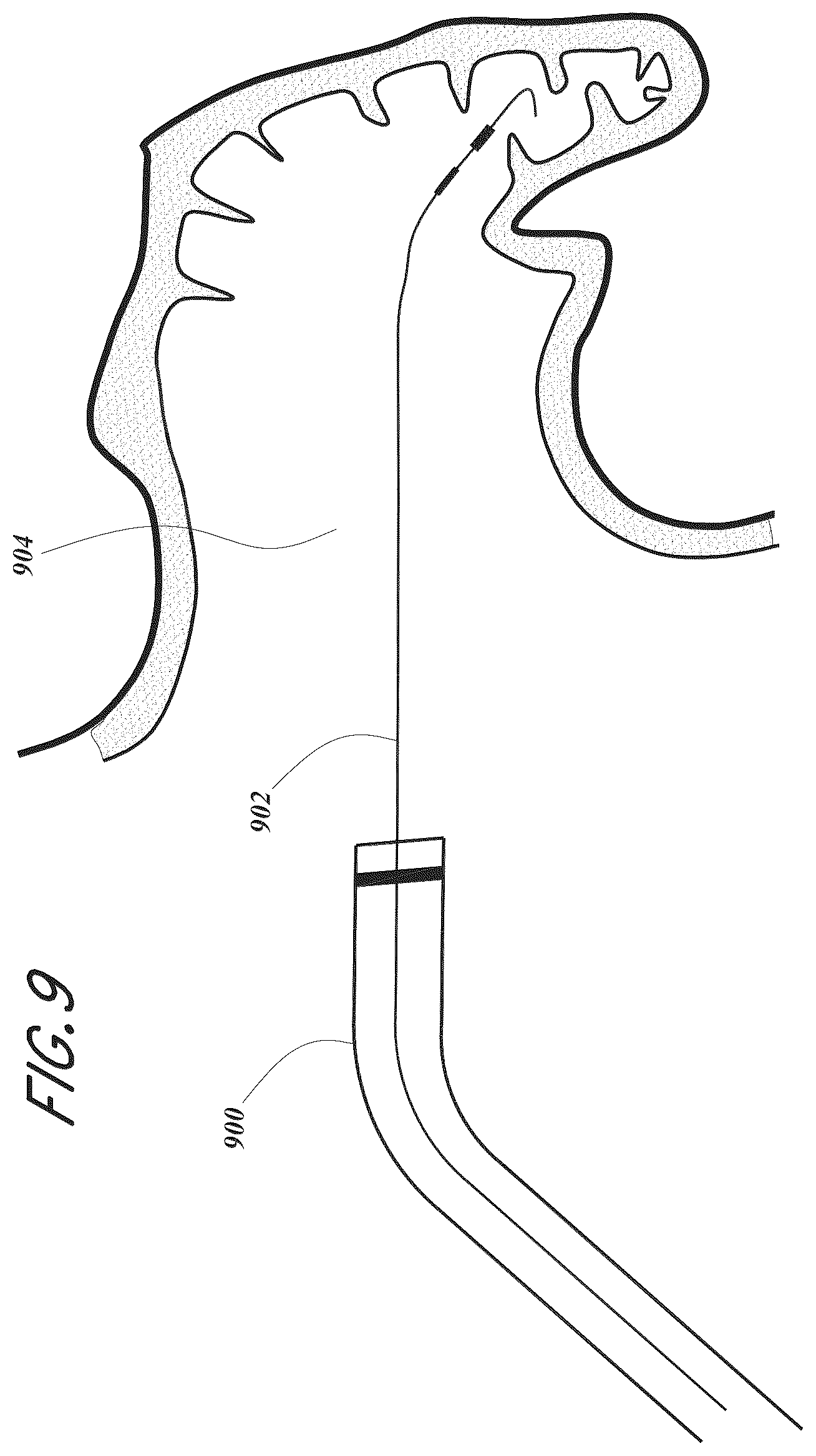 Patent US12167856 Figure 9 – Devices and methods for excluding the left atrial appendage