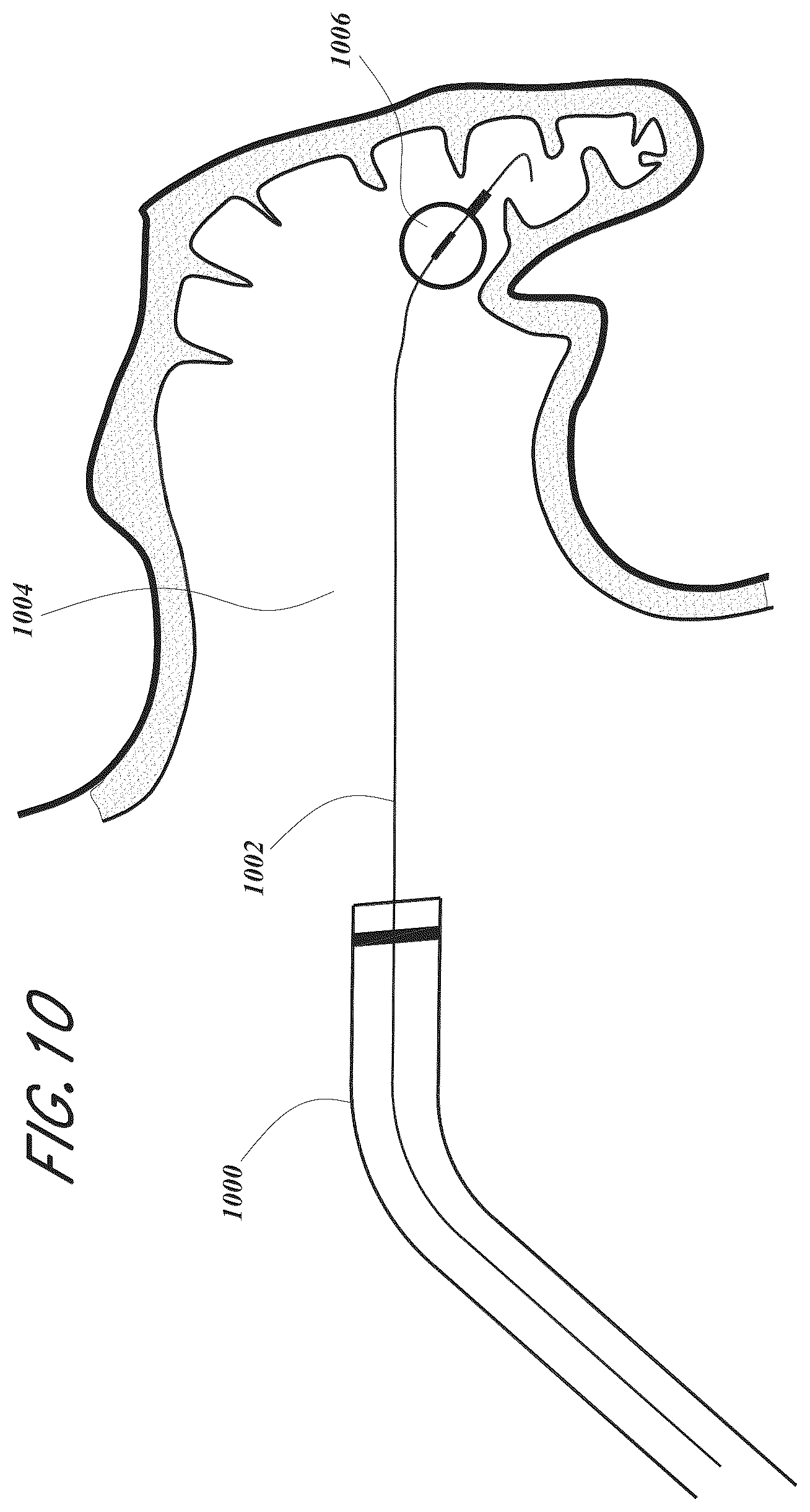 Patent US12167856 Figure 10 – Devices and methods for excluding the left atrial appendage