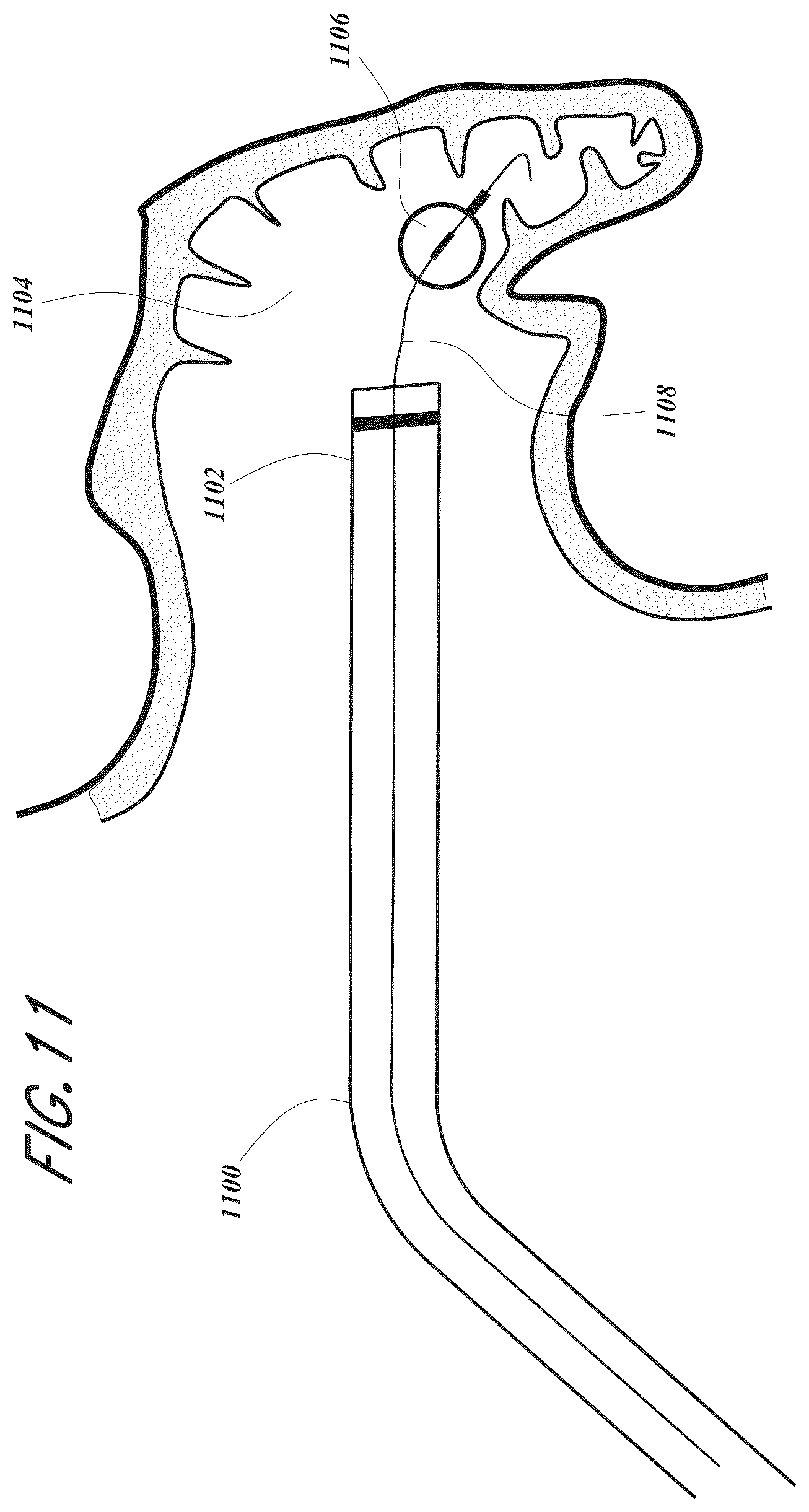 Patent US12167856 Figure 11 – Devices and methods for excluding the left atrial appendage