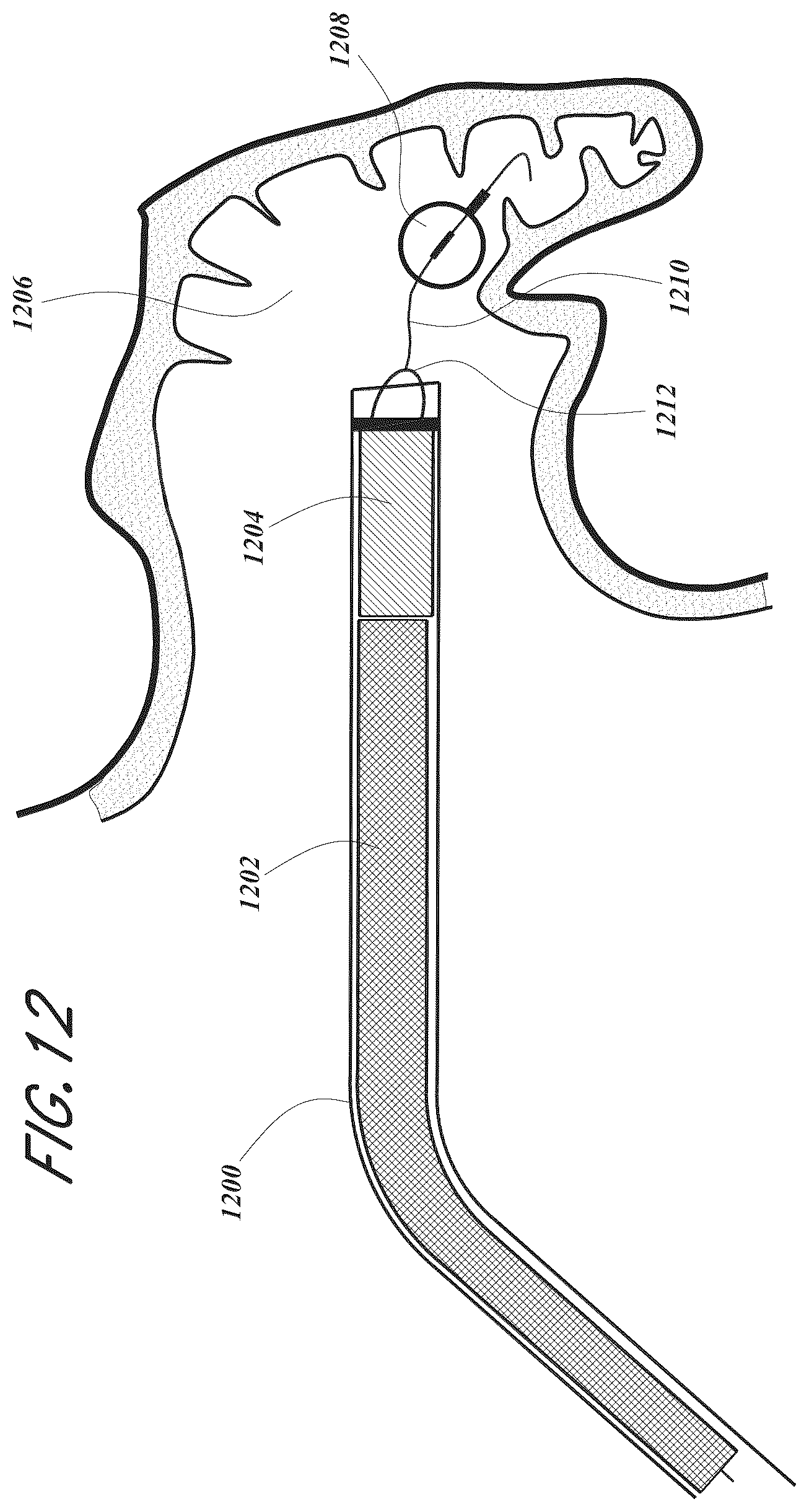 Patent US12167856 Figure 12 – Devices and methods for excluding the left atrial appendage