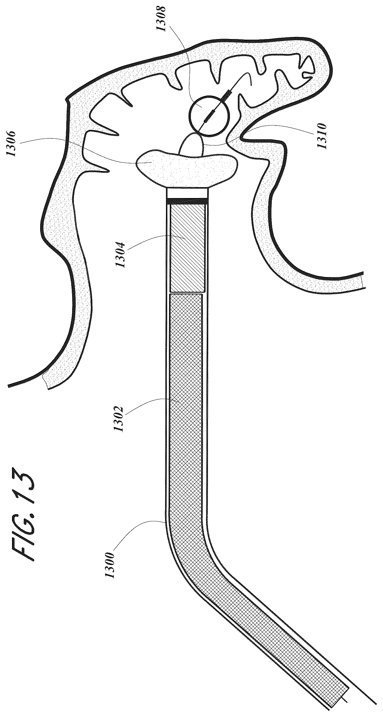 Patent US12167856 Figure 13 – Devices and methods for excluding the left atrial appendage
