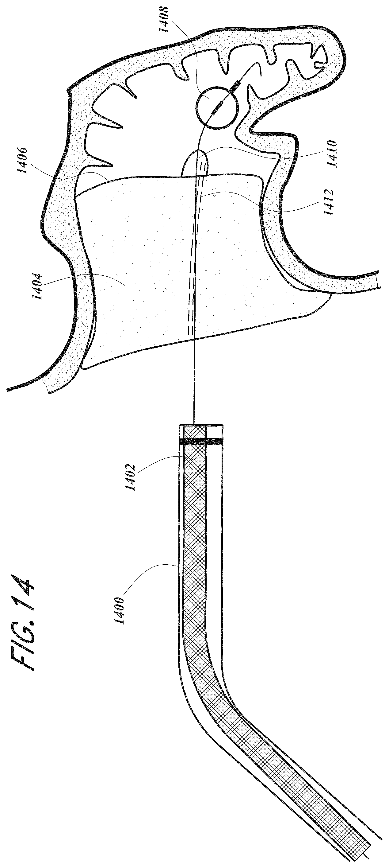 Patent US12167856 Figure 14 – Devices and methods for excluding the left atrial appendage