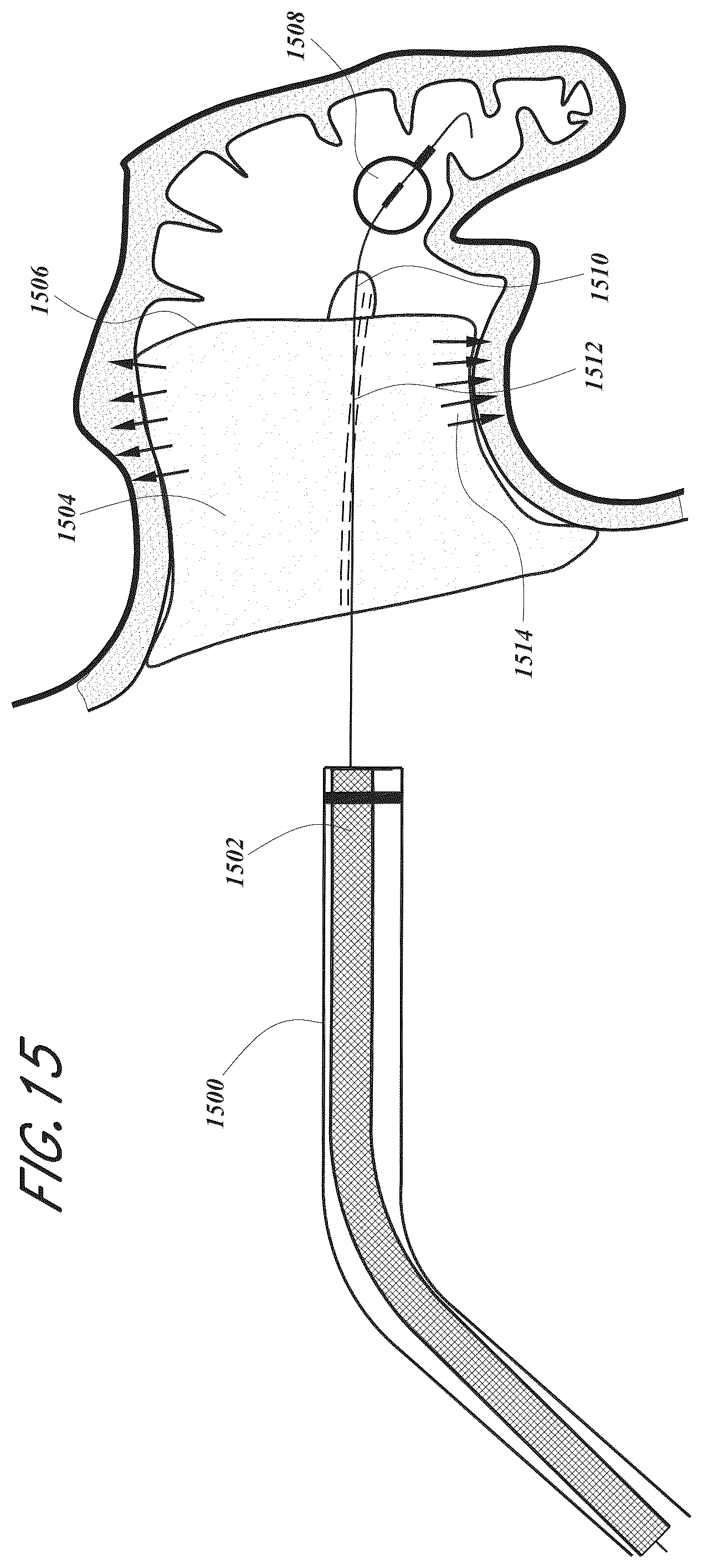 Patent US12167856 Figure 15 – Devices and methods for excluding the left atrial appendage