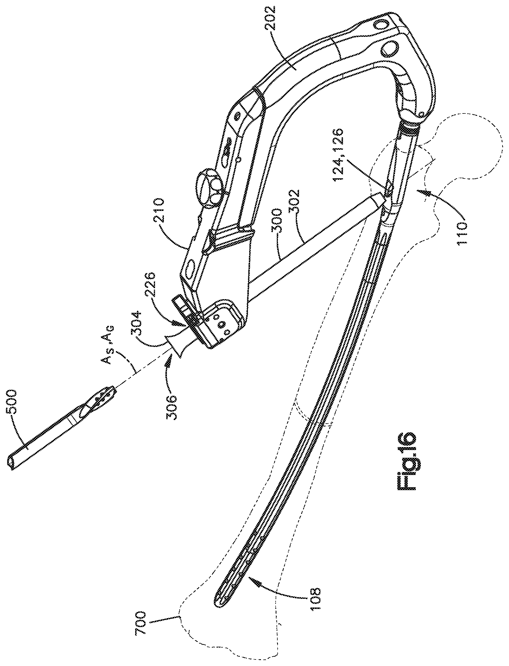 Patent US12167859 Figure 7 – Intramedullary nail with wire or magnet for targeting of a bone-anchor locking hole