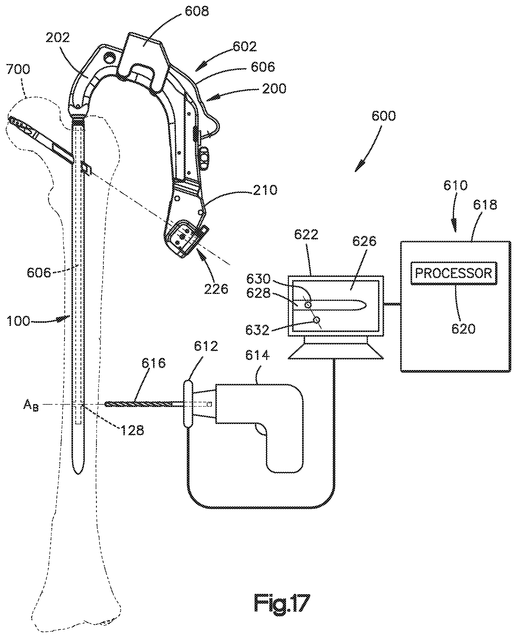 Patent US12167859 Figure 8 – Intramedullary nail with wire or magnet for targeting of a bone-anchor locking hole
