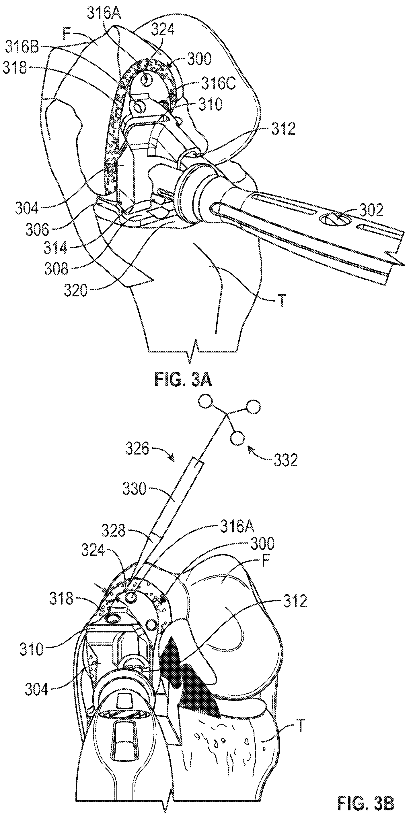 Patent US12167860 Figure 3 – Devices and methods for posterior resection in robotically assisted partial knee arthroplasties