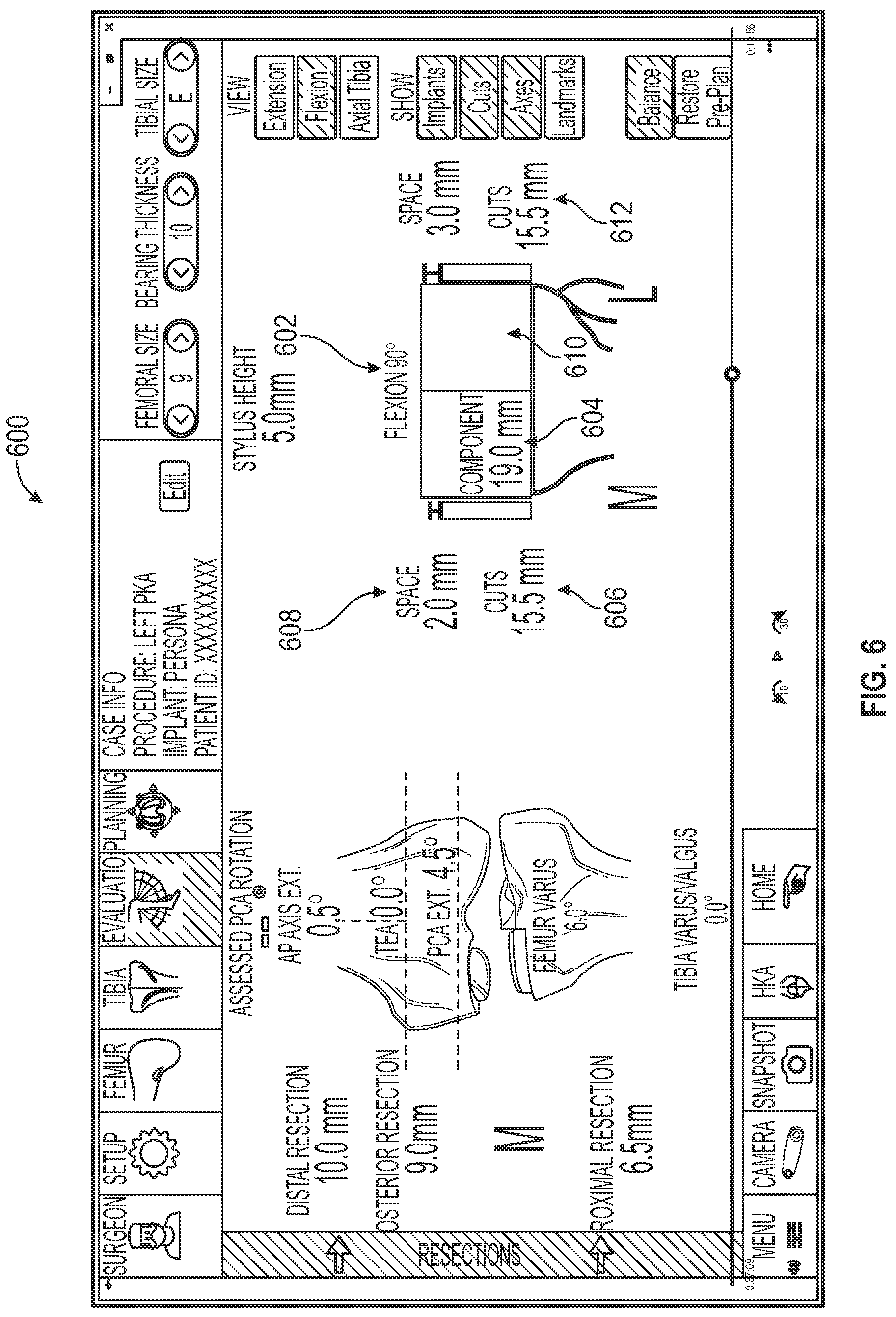 Patent US12167860 Figure 10 – Devices and methods for posterior resection in robotically assisted partial knee arthroplasties