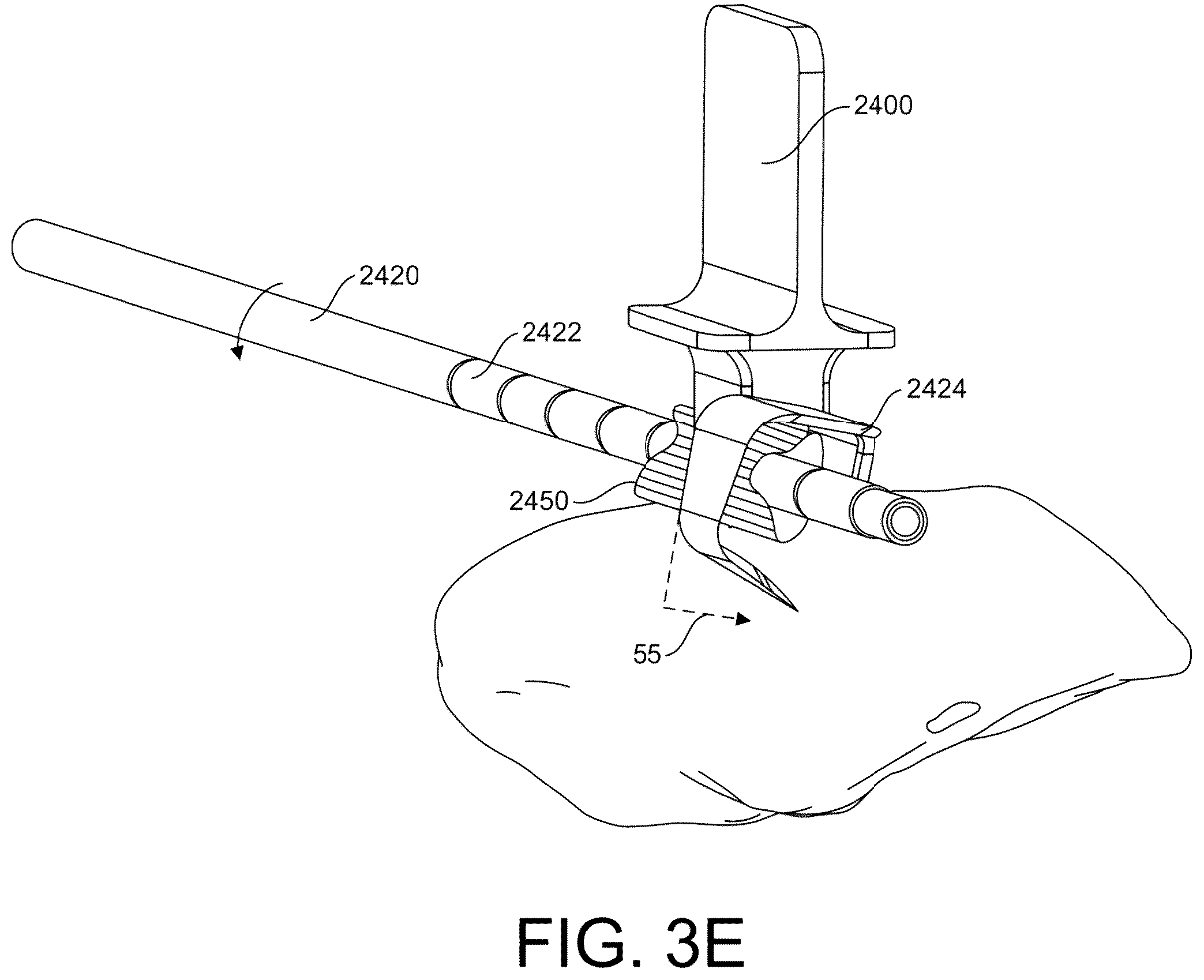 Patent US12167861 Figure 16 – Tendon harvesting system