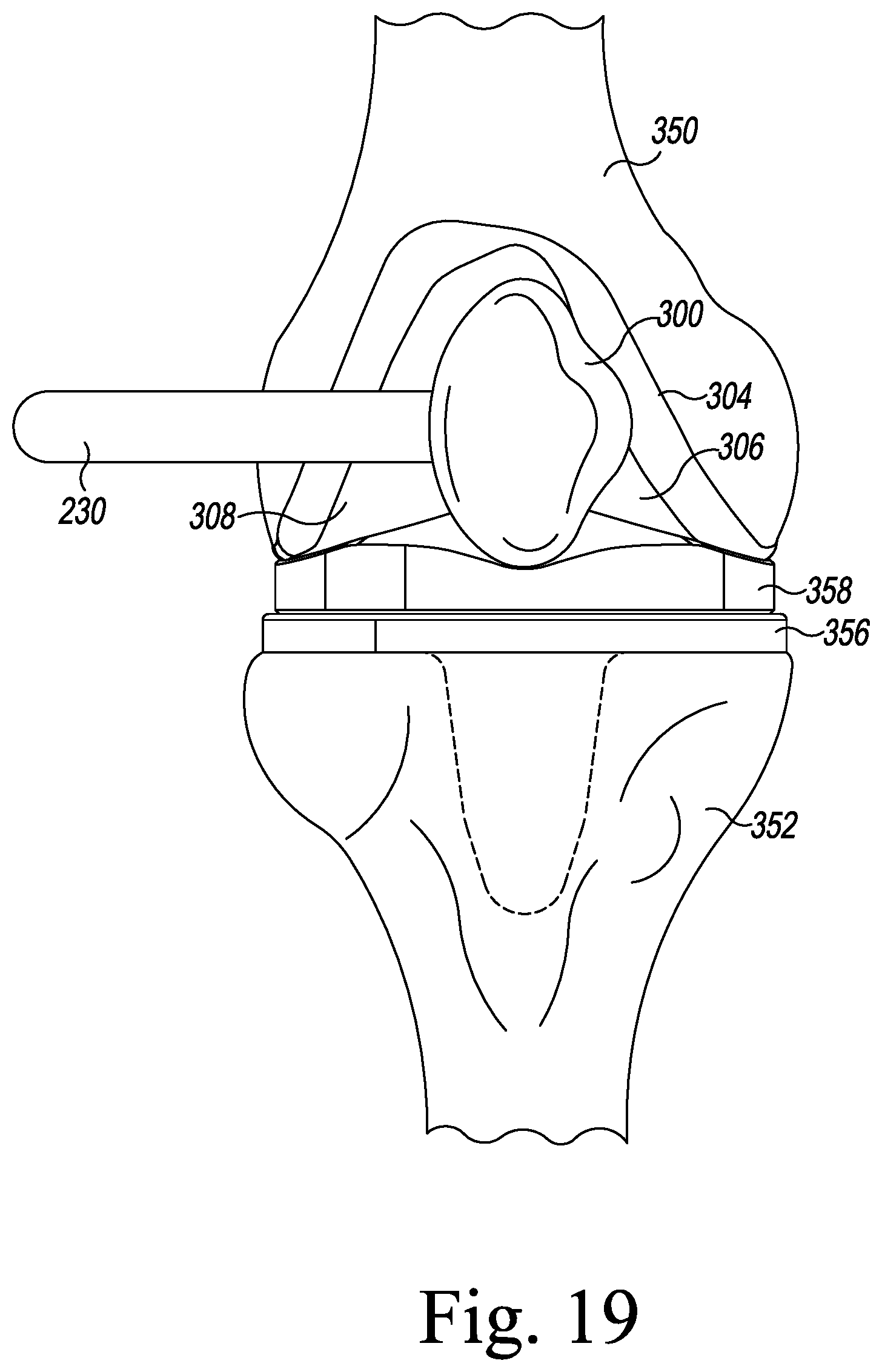 Patent US12167862 Figure 12 – Orthopaedic surgical instrument system for implanting a prosthetic patella component and method of use