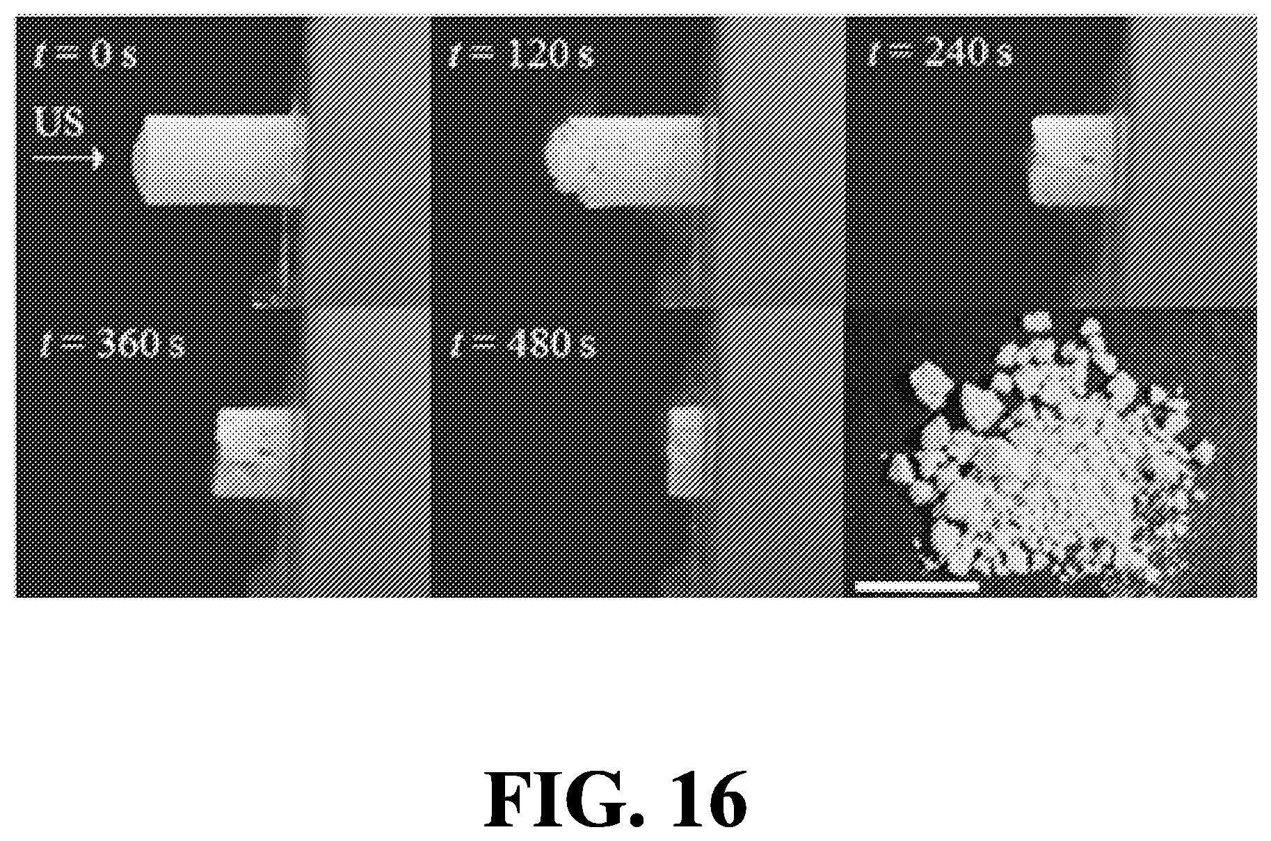 Patent US12167864 Figure 19 – Noninvasive fragmentation of urinary tract stones with focused ultrasound