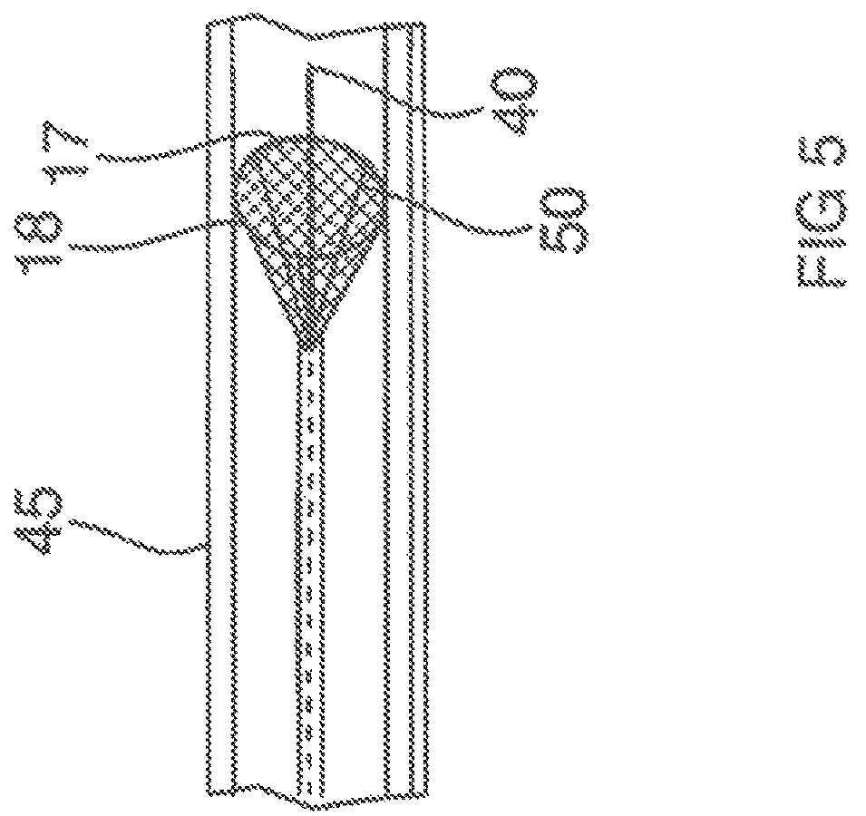 Patent US12167865 Figure 4 – Minimally invasive thrombectomy
