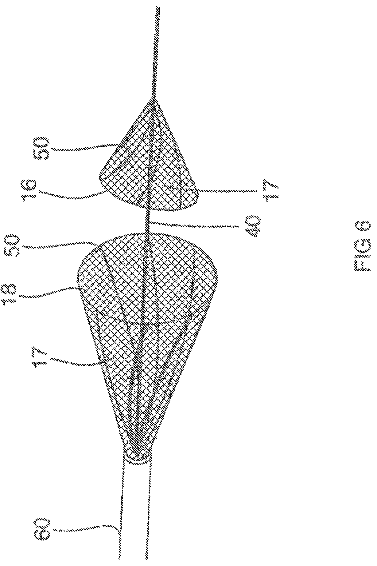 Patent US12167865 Figure 5 – Minimally invasive thrombectomy