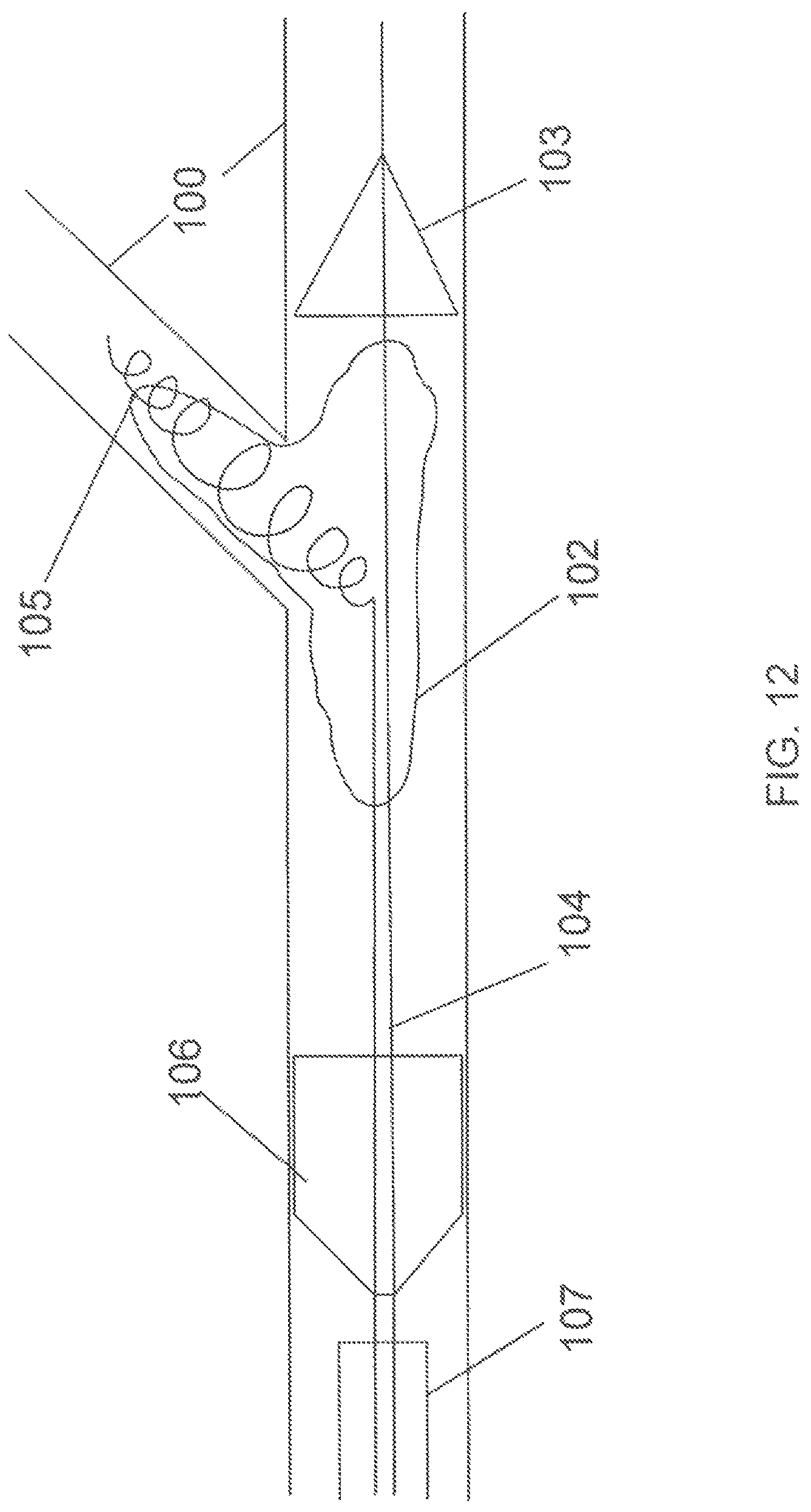 Patent US12167865 Figure 10 – Minimally invasive thrombectomy