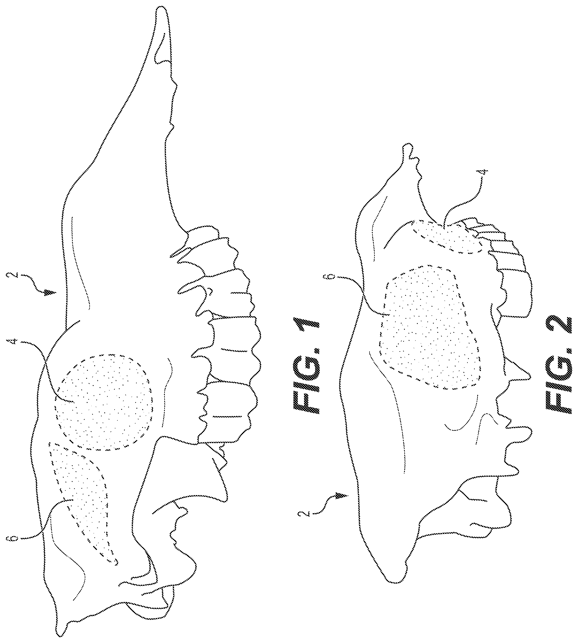 Patent US12167868 Figure 1 – Enucleation-exenteration approach of the camel eye via the supraorbital fossa