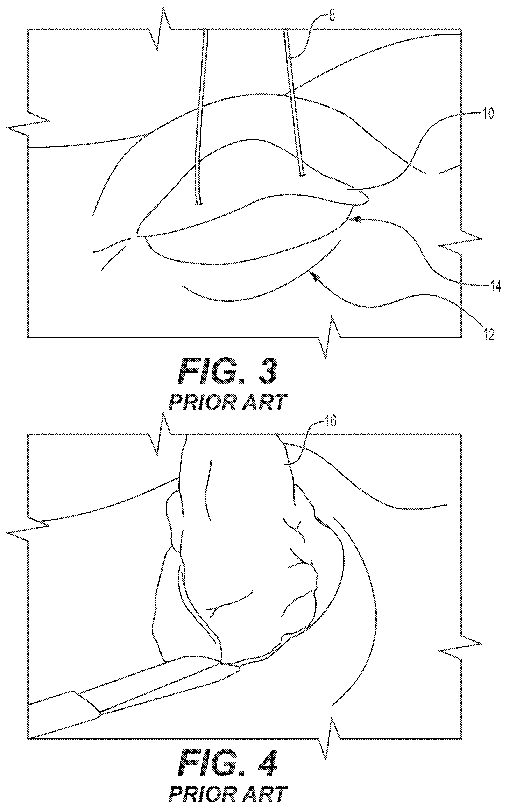 Patent US12167868 Figure 2 – Enucleation-exenteration approach of the camel eye via the supraorbital fossa