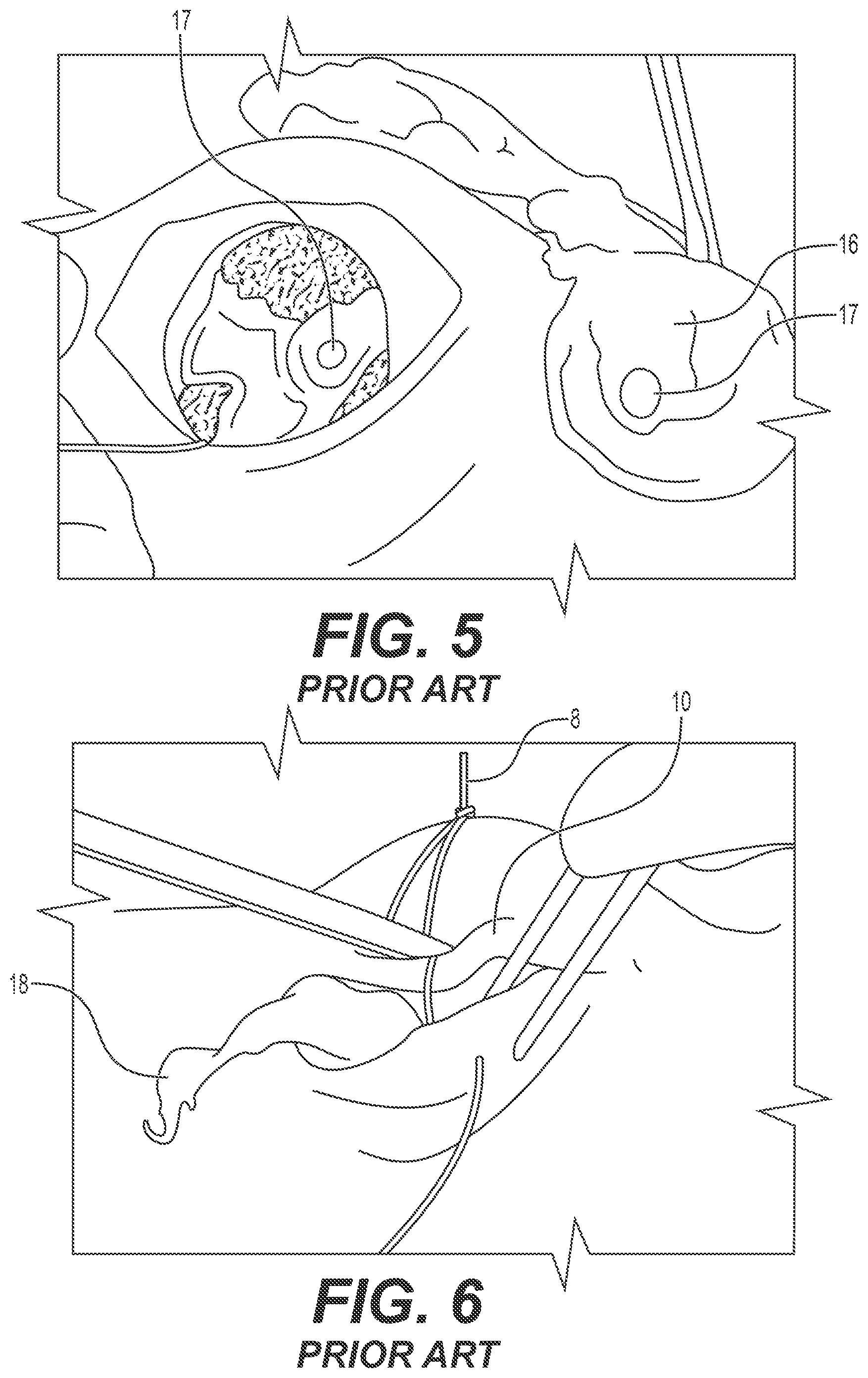 Patent US12167868 Figure 3 – Enucleation-exenteration approach of the camel eye via the supraorbital fossa