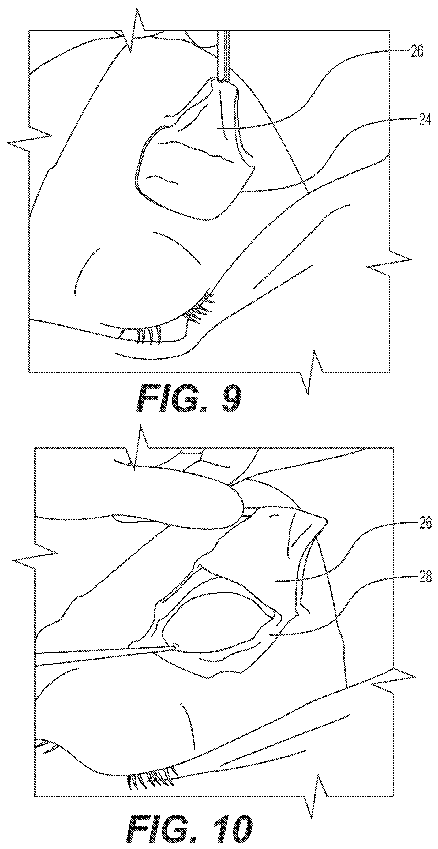 Patent US12167868 Figure 5 – Enucleation-exenteration approach of the camel eye via the supraorbital fossa