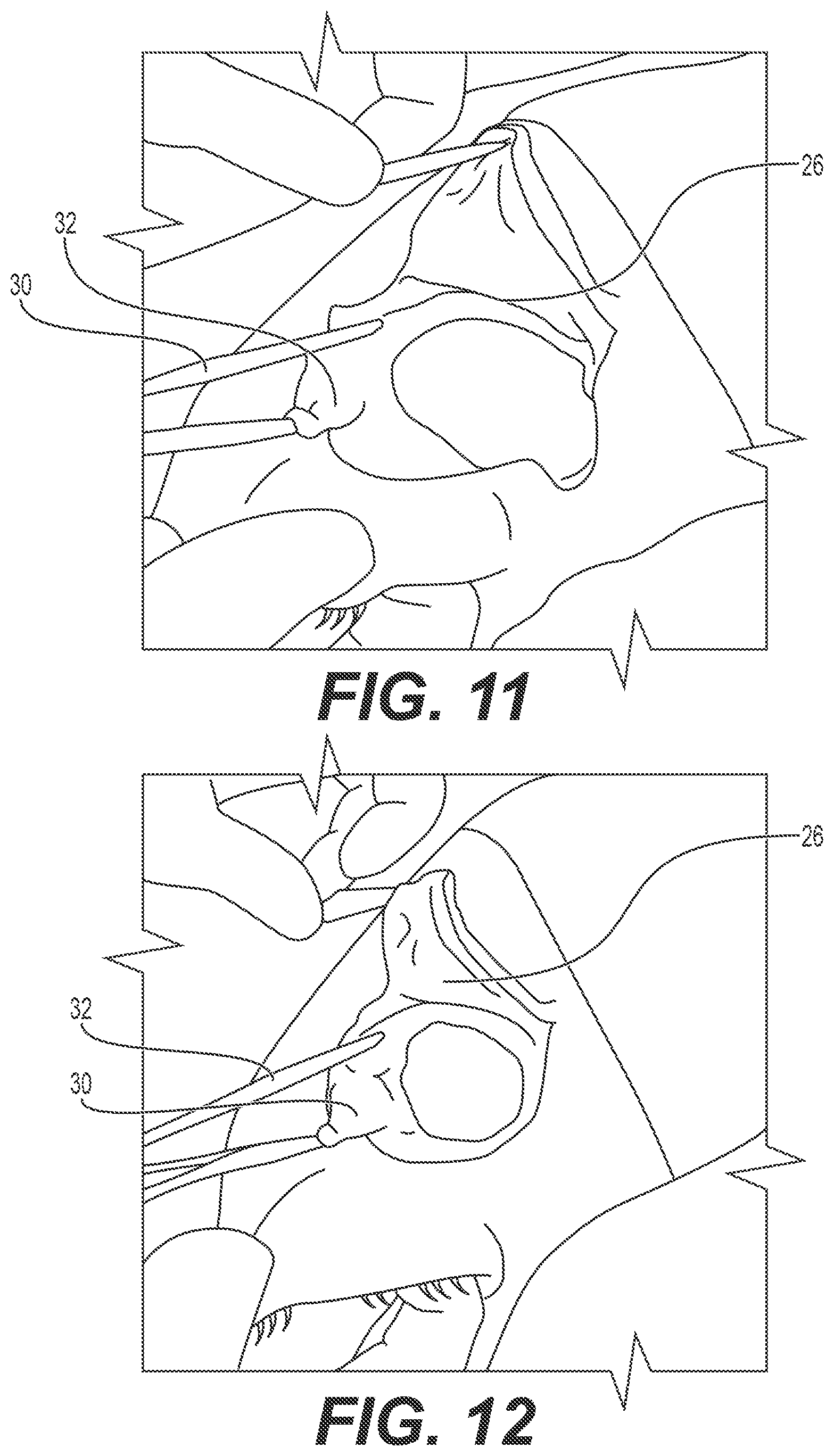 Patent US12167868 Figure 6 – Enucleation-exenteration approach of the camel eye via the supraorbital fossa